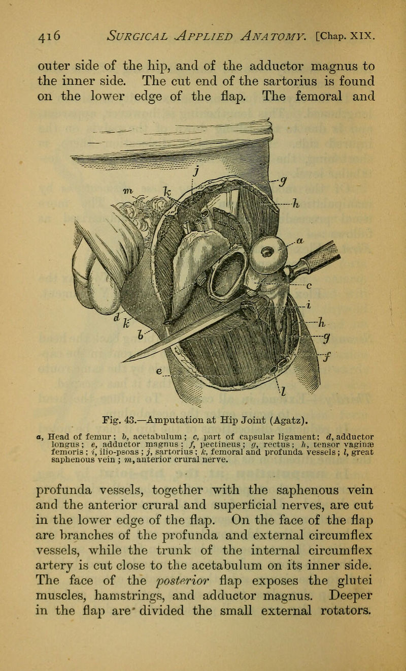 outer side of the hip, and of the adductor magnus to the inner side. The cut end of the sartorius is found on the lower edge of the flap. The femoral and Fig. 43.—Amputation at Hij) Joint (Agatz). a. Head of femur: h, acetaljiiluin; c, part of capsular ligament; <f, adductor longus; e, adductor magnus: /, pectineus; g, rectus; /(, tensor vagiute femoris; i, ilio-psoas ; j, sartorius; k, femoral aiid profunda vessels; I, great saphenous vein ; ?*i, anterior crural nerve. profunda vessels, together with the saphenous vein and the anterior crural and superficial nerves, are cut in the lower edge of the flap. On the face of the flap are branches of the profunda and external circumflex vessels, while the trunk of the internal circumflex artery is cut close to the acetabulum on its inner side. The face of the posterior flap exposes the glutei muscles, hamstrings, and adductor magnus. Deeper in the flap are' divided the small external rotators.