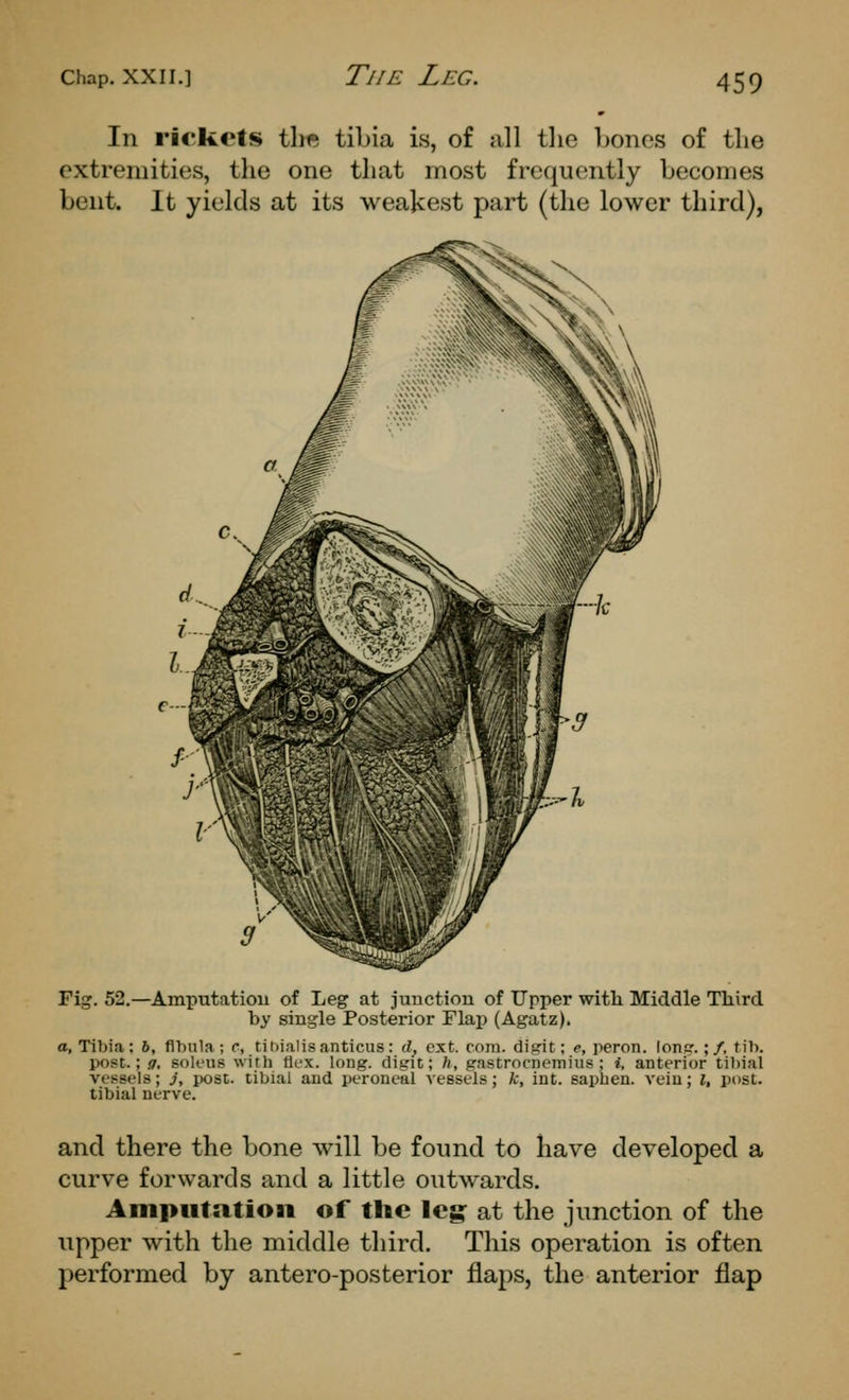 The Leg. In rickets tht? tibia is, of all tlie Lones of the extremities, the one that most frequently becomes bent. It yields at its weakest part (the lower third), Fig. 52.—Amputatiou of Leg at junction of Upper witli Middle Third by single Posterior Flaj) (Agatz). a, Tibia: 6, fibula; c, tihialisanticus: il, ext. com. digit; e, peron. loner.;/, tib. post.; g, sok'us with flex. long, digit; ft, gastrocnemius; t, anterior tibial vessels; i, post, tibial and peroneal vessels; A;, int. sapben. vein; {, post, tibial nerve. and there the bone will be found to have developed a curve forwards and a little outwards. Amputation of the leg at the junction of the upper with the middle third. This operation is often performed by antero-posterior flaps, the anterior flap