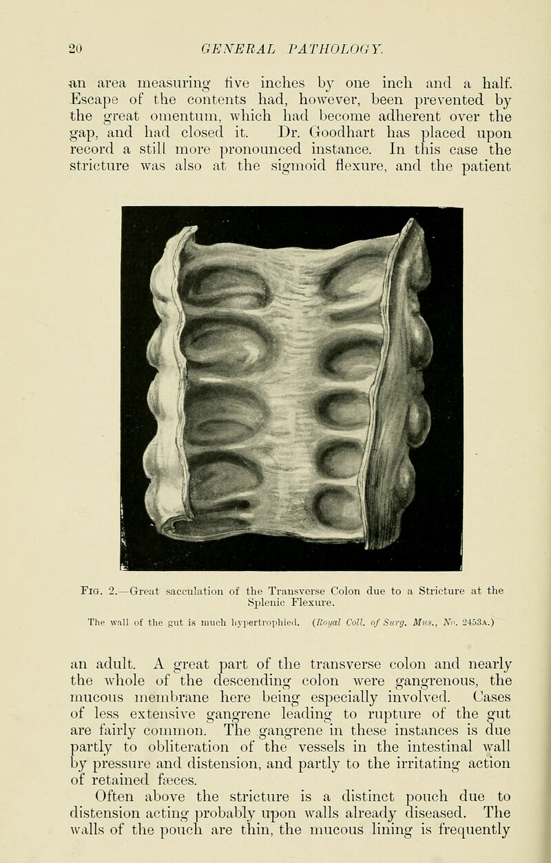 an area measuring live inches by one inch and a half. -Escape of the contents had, however, been prevented by the great omentum, which had become adherent over the gap, and had closed it. Dr. Goodhart has placed upon record a still more pronounced instance. In this case the stricture was also at the sigmoid flexure, and the patient Fig. 2.—Great sacculatiou of the Trausvorse Colon due to a Stricture at the Splenic Flexiu-e. The wall of the gut is much liypertropliied. (Royal Coll. of Surg. Mus., No. 2453a.) an adult. A great part of the transverse colon and nearly the whole of the descendino' colon were o-ano-renous, the mucous membrane here being especially involved. Cases of less extensive gangrene leading to rupture of the gut are fairly common. The gangrene in these instances is due partly to obliteration of the vessels in the intestinal wall by pressure and distension, and partly to the irritating action of retained faeces. Often above the stricture is a distinct pouch due to distension acting probably upon walls already diseased. The walls of the pouch are thin, the mucous lining is frequently