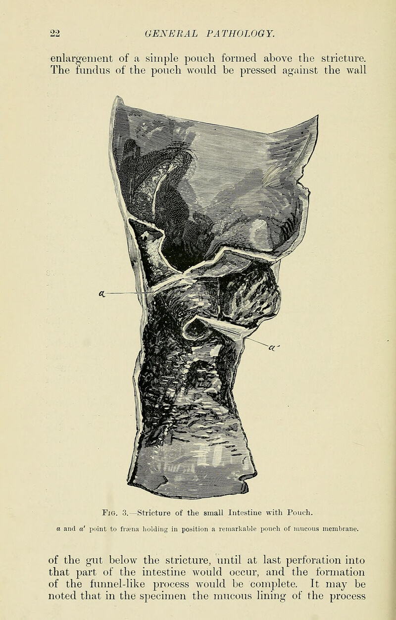 enlargement of a simple pouch formed above the stricture. The fundus of the pouch would be pressed against the wall Fjg. 3.—Stricture of the small Intestine with Pouch. a and a' point to fra;na liolding in position a reniarlialile pouch of niucous membrane. of the gut below the stricture, until at last perforation into that part of the intestine would occur, and the formation of the funnel-like process would be complete. It may be noted that in the specimen the mucous lining of the process