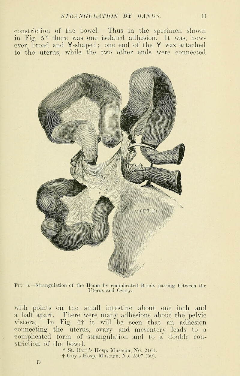 constriction of the bowel. Thus in the specimen shown in Fig. 5^ there was one isolated adhesion. It was, how- ever, broad and Y-shaped; one end of the Y was attached to the uterus, while the two other ends were connected Fig. 6.—Strangulatiou of the Ileum by complicated Baucis iDassing between the Uterus and Ovary. with points on the small intestine about one inch and a half apart. There were man}' adhesions about the pelvic viscera. In Fig. 6t it will be seen that an adhesion connecting the uterus, ovary and mesentery leads to a complicated form of strangulation and to a double con- striction of the bowel. * St. Bart.'s Hosp. Museum, No. 2164. t Gu3''s Hosp. Museum, No. 2507 (50). D