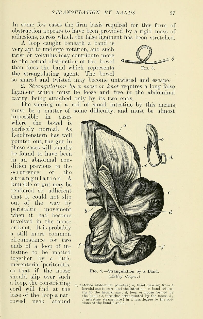 Fig. 8. In some few cases the firm basis required for this form of obstruction appears to have been provided by a rigid mass of adhesions, across which the false hgament has been stretched. A loop caught beneath a band is very apt to undergo rotation, and such twist or volvulus may contribute more to the actual obstruction of the bowel than does the band which represents the strangulating agent. The bowel so snared and twisted may become untwisted and escape. 2. Strangulation by a noose or knot requires a long false ligament which must lie loose and free in the abdominal cavity, being attached only by its two ends. The snaring of a coil of small intestine by this means must be a matter of some difficulty, and must be almost impossible in cases where the bowel is perfectly normal. As Leichtenstern has well pointed out, the gut in these cases will usually be found to have been in an abnormal con- dition previous to the occurrence of the strangulation. A knuckle of gut may be rendered so adherent that it could not slip out of the way by peristaltic movement when it had become involved in the noose or knot. It is probably a still more common circumstance for two ends of a loop of in- testine to be matted together by a little mesenterial peritonitis, so that if the noose should slip over such a loop, the constricting cord will find at the base of the loop a nar- rowed neck around Fig. 9. -Strangulation by a Band. {Astley CoojH'r.) a, anterior abdominal parietes ; ';, band passing from a hernial sac to surround the intestine ; c, band return- ing to the hernial sac ; d, loop or noose formed by the band; e, intestine strangulated by the noose d; f, intestine strangulated in a less degree by the por- tions of thp band h and c.