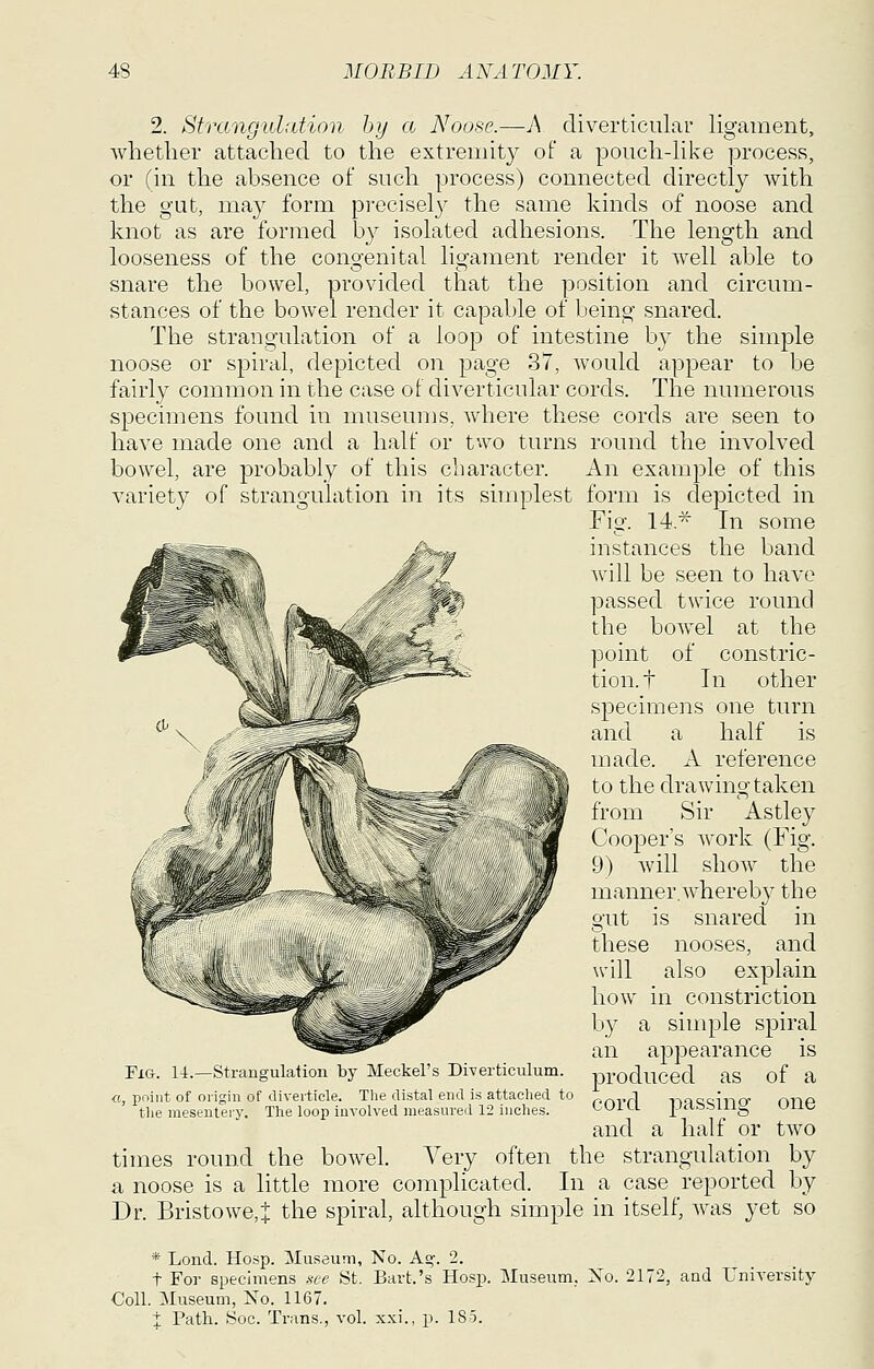 2. Strangulation hy a Noose.—A diverticular ligament, whether attached to the extremity of a pouch-like process, or (in the absence of such process) connected directlj with the gut, may form precisel}^ the same kinds of noose and knot as are formed by isolated adhesions. The length and looseness of the congenital ligament render it well able to snare the bowel, provided that the position and circum- stances of the bowel render it capable of being snared. The strangulation of a loop of intestine b} the simple noose or spiral, depicted on page 37, would appear to be fairly common in the case of diverticular cords. The numerous specimens found in museums, where these cords are seen to have made one and a half or two turns round the involved bowel, are probably of this character. An example of this variety of strangulation in its simplest form is depicted in Fig. 14'^ In some instances the band will be seen to have passed twice round the bowel at the point of constric- tion, t In other specimens one turn and a half is made. A reference to the drawing taken from Sir Astley Cooper's work (Fig. 9) will show the manner,whereby the gut is snared in these nooses, and will also explain how in constriction by a simple spiral an appearance is produced as of a cord 2:)assing one and a half or two times round the boAvel. Very often the strangulation by a noose is a little more complicated. In a case reported by Dr. Bristowe,J the spiral, although simple in itself, was yet so Fig. U.—Strangulation by Meckel's Diverticulum. «, point of origin of diverticle. The distal end is attached to the meseutery. The loop involved measured 12 inches. * Lond. Hosp. Museum, No. A-. 2. t For specimens .we St. Bart.'s Hosp. Museum, Xo. 2172, and University Coll. Museum, No. 1167. 1 Path. Soc. Trans., vol. xxi., p. 185.