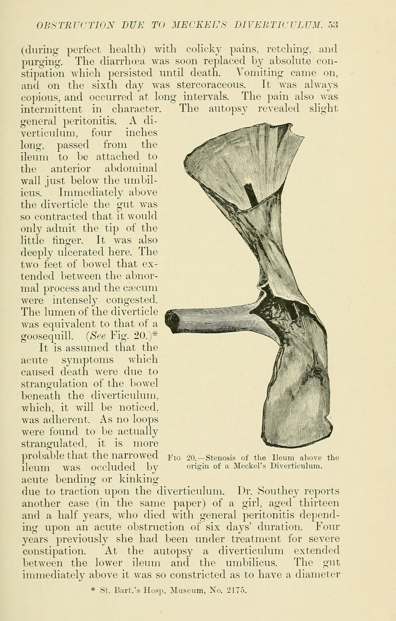 (during perfect health) with coHcky pains, retching, and purging. The charrhoea was soon replaced by absolute con- stipation which persisted until death. Vomiting came on, and on the sixth day Avas stercoraceous. It was always copious, and occurred at long intervals. The pain also was intermittent in character. The autopsy revealed slight general peritonitis. A di- verticulum, four inches long, passed from the ileum to be attached to the anterior abdominal wall just below the umbil- icus. Immediately above the diverticle the gut was so contracted that it would only admit the tip of the little finger. It was also deepl}' ulcerated here. The two feet of bowel that ex- tended between the abnor- mal process and the caecum were intensely congested. The lumen of the diverticle was equivalent to that of a goosequill. (See Fig. 20.)* It is assumed that the acute symptoms which caused death w^ere due to strangulation of the bowel beneath the diverticulum, which, it will be noticed, was adherent. As no loops were found to be actuall}^ strangulated, it is more probable that the narrowed Yig 20.—stenosis of the ileum above the ileum was occluded by origm of a Meckel's Diyerticulmn. acute bending or kinking due to traction upon the diverticulum. Dr. Southe} reports another case (in the same paper) of a girl, aged thirteen and a half years, who died with general peritonitis depend- ing upon an acute obstruction of six days' duration. Four years previously she had been under treatment for severe constipation. At the autopsy a diverticulum extended between the lower ileum and the umbilicus. The gut innnediately above it was so constricted as to have a diameter * St. Bart.'s Hosp. Museum, No. 2175.