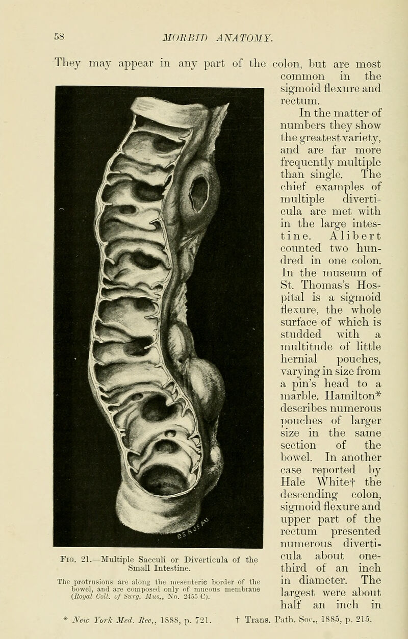 They may appear in any part of the colon, but Fig. 21.—Multiple Sacculi or Diverticula of Small Intestine. the The protrusions are along the mesenteric border of the bowel, and are composed only of mucous membrane {Royal Coll. of Surg. Mus., No. 2455 C). are most common in the sigmoid flexure and rectum. In the matter of numbers they show the greatest variety, and are far more frequently multiple than single. The chief examples of multiple diverti- cula are met with in the large intes- tine. Alibert counted two hun- dred in one colon. In the museum of St. Thomas's Hos- pital is a sigmoid flexure, the whole surface of which is studded with a multitude of little hernial jjouches, varying in size from a pin's head to a marble. Hamilton^ describes numerous pouches of larger size in the sanie section of the boAvel. In another case reported by Hale Whitet the descending colon, sigmoid flexure and upper part of the rectum presented numerous diverti- cula about one- third of an inch diameter. The were about inch in in largest half an * A'eiv York Med. Eec, 1S8S, p. 721. t Trans. Path. Soc, 1885, p. 215.