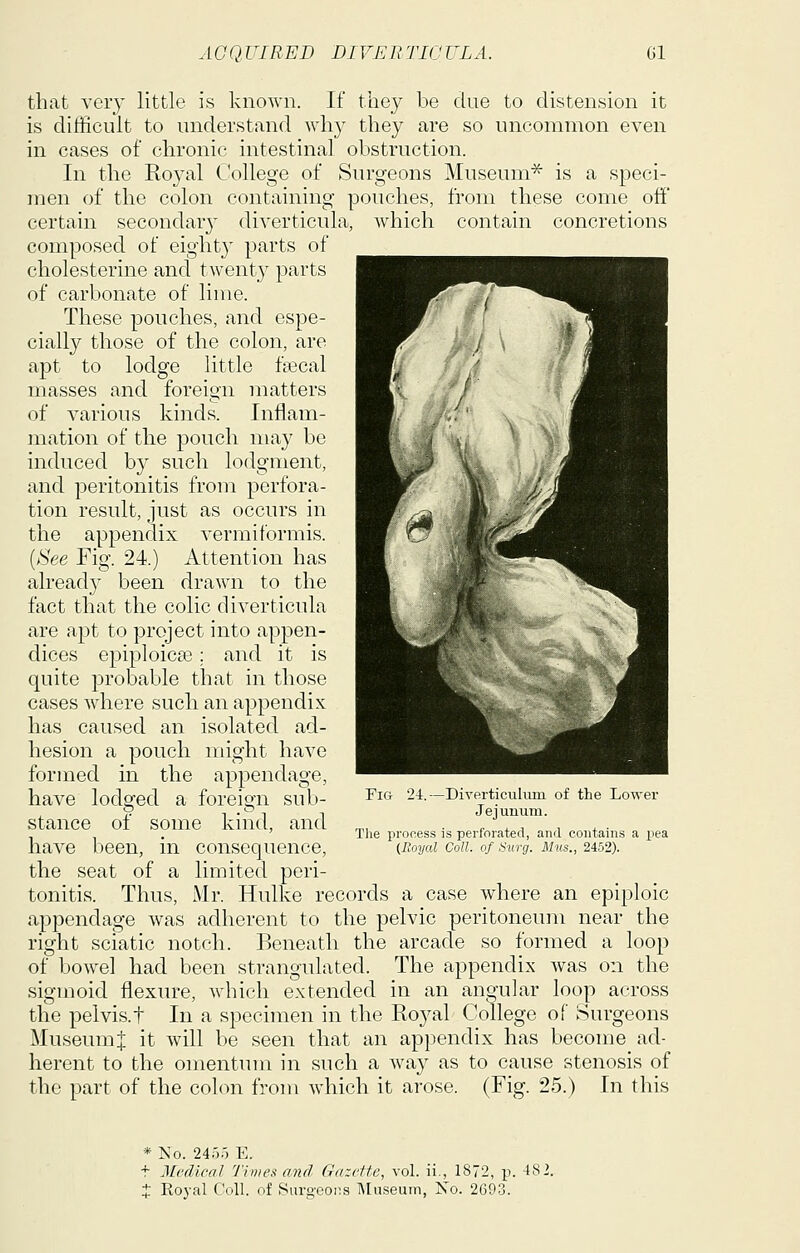 AGQ UIRED DIVEB TIC ULA. Gl that very little is known. If tliey be due to distension it is difficult to understand why they are so uncommon even in cases of chronic intestinal obstruction. In the Royal College of Surgeons Museum^ is a speci- men of the colon containing pouches, from these come off certain seconclar}- diverticula, which contain concretions composed of eighty parts of cholesterine and twenty parts of carbonate of lime. These pouches, and espe- cially those of the colon, are apt to lodge little fascal masses and foreign matters of various kinds. Inflam- mation of the pouch may be induced by such lodgment, and peritonitis from perfora- tion result, just as occurs in the appendix vermiformis. (iS'ee Fig. 24.) Attention has already been drawn to the fact that the colic diverticula are apt to project into appen- dices epiploic^ : and it is quite 23robable that in those cases where such, an appendix has caused an isolated ad- hesion a pouch might have formed in the appendage, have lodged a foreign sub- stance of some kind, and have been, in consequence, the seat of a limited peri- tonitis. Thus, Mr. Hulke records a case where an epiploic appendage was adherent to the pelvic peritoneum near the right sciatic notch. Beneath the arcade so formed a loop of bowel had been strangulated. The appendix was on the sigmoid flexure, which extended in an angular loop across the pelvis.t In a specimen in the Royal College of Surgeons Museum J it will be seen that an appendix has become ad- herent to the omentum in such a way as to cause stenosis of the part of the colon from which it arose. (Fig. 25.) In this Fig 24.—Diverticulum of the Lower Jejunum. The process is perforated, and contains a pea (Royal Coll. of Siirg. Mils., 2452). * No. 24').') E. t Medical 7'imes and Gazette, vol. ii., 1872, p. 482.