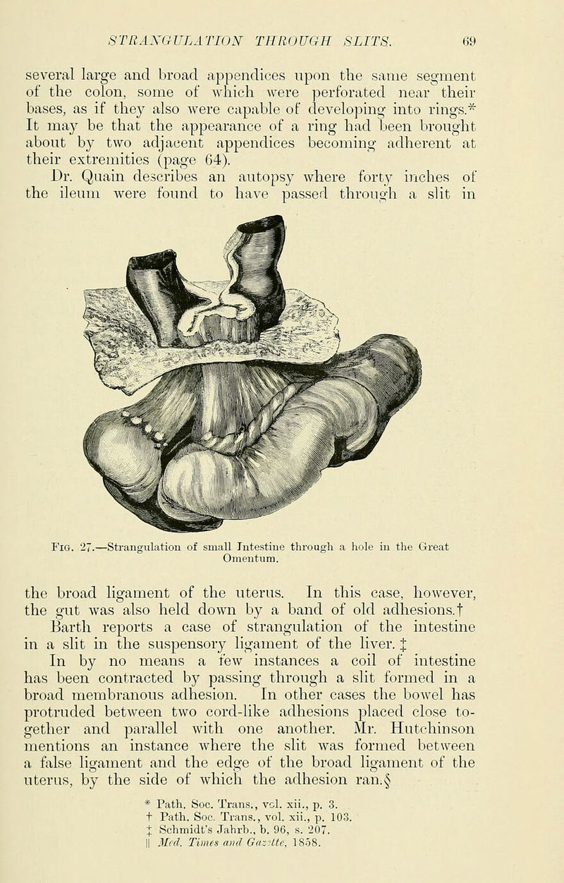 several large and broad appendices upon the same segment of the colon, some of which were perforated near their bases, as if they also were capable of developing into rings.^ It may be that the appearance of a ring had been brought about by two adjacent appendices becoming adherent at their extremities (page 64). Dr. Quain describes an autopsy where forty inches of the ileum were found to have passed through a slit in Fig. -Strangulatiou of small Intestine through a hole in the Great Omentum. the broad ligament of the uterus. In this case, however, the gut was also held down by a band of old adhesions, f Barth reports a case of strangulation of the intestine in a slit in the suspensory ligament of the liver. J In by no means a few instances a coil of intestine has been contracted by passing through a slit formed in a broad membranous adhesion. In other cases the bowel has protruded between two cord-like adhesions placed close to- gether and parallel with one another. Mr. Hutchinson mentions an instance where the slit was formed between a false ligament and the edge of the broad ligament of the uterus, by the side of which the adhesion ran.§ * Path. Soc. Trans., vol. xii., p. 3. t Path. Soc. Trans., vol. xii., p. 103. + Schmidt's Jahrb., b. 96, s. 207. li Med. Times and GttzHte, 1858.