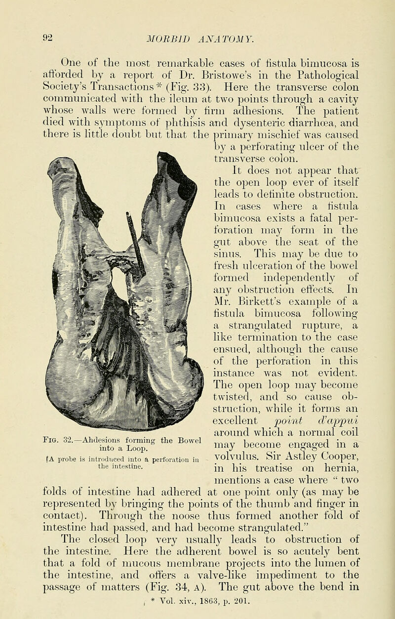One of tlie most remarkable cases of fistula bimucosa is afifbrded by a report of Dr. Bristowe's in the Pathological Society's Transactions^ (Fig. 33). Here the transverse colon communicated with the ileum at two points through a cavity whose walls were formed by firm adhesions. The patient died with symptoms of phthisis and dysenteric diarrhoea, and there is little doubt but that the primary mischief was caused by a perforating ulcer of the transverse colon. It does not appear that the open loop ever of itself leads to definite obstruction. In cases where a fistula bimucosa exists a fatal per- foration may form in the gut above the seat of the sinus. This may be due to fresh ulceration of the bowel formed independently of any obstruction effects. In Mr. Birkett's example of a fistula bimucosa following a strangidated rupture, a like termination to the case ensued, althous^h the cause of the perforation in this instance was not evident. The open loop may become twisted, and so cause ob- struction, while it forms an excellent point d'appui around which a normal coil may become engaged in a volvulus. Sir Astley Cooper, in his treatise on hernia, mentions a case where  two folds of intestine had adhered at one point only (as may be represented by bringing the points of the thumb and finger in contact). Through the noose thus formed another fold of intestine had passed, and had become strangulated. The closed loop very usually leads to obstruction of the intestine. Here the adherent bowel is so acutely bent that a fold of mucous membrane projects into the lumen of the intestine, and offers a valve-like impediment to the passage of matters (Fig. 34, a). The gut above the bend in i * Vol. xiv., 1863, 1). 201. Fig. 32.—Ahdesious forming the Bowel into a Loop. fA probe is introdviced into a perforation in the intestine.