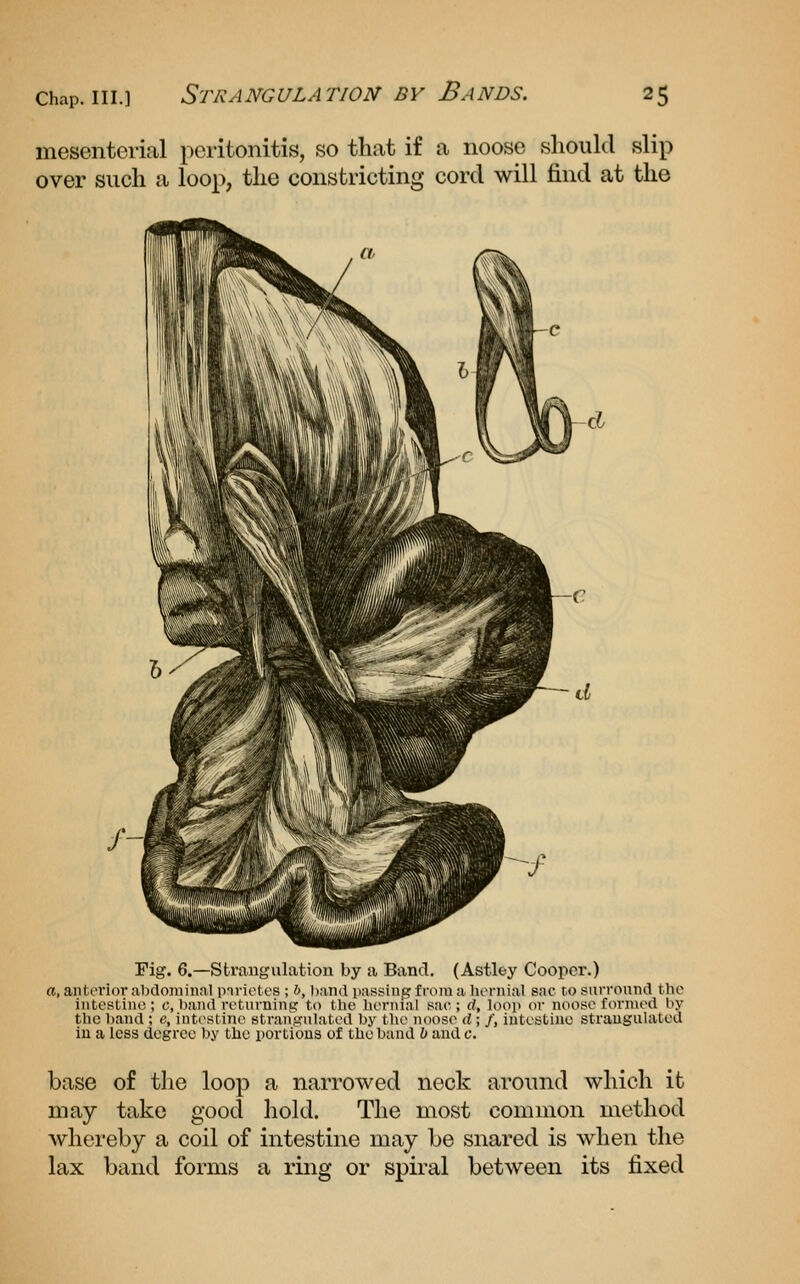 mesenterial peritonitis, so that if a noose should slip over such a loop, the constricting cord will find at the Fig. 6.—Strangulation by a Band. (Astlty Cooper.) a, anterior al)clonilnal parietes ; h, hand passing from a lu'vnial sac to surround the intestine ; c, band returning to the hernial sac ; d, loop or noose fonned by the band ; e, intestine strangulated by the noose d; /, intestine strauguhvted iu a less degree by the portions of the band h and c. base of tJie loop a narrowed neck around which it may take good hold. The most common method whereby a coil of intestine may be snared is when the lax band forms a ring or spiral between its fixed