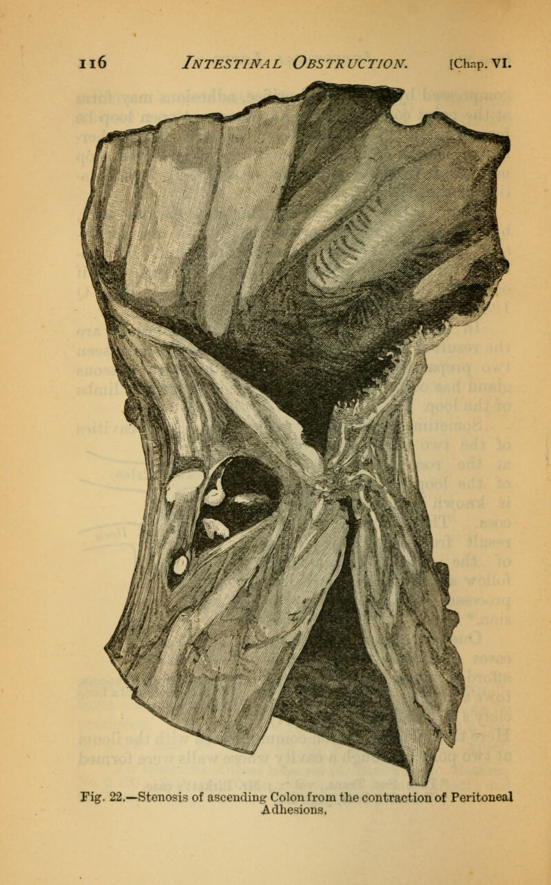 Fig. 22.—Stenosis of ascendingr Colon from the contraction of Peritoneal Adhesions.