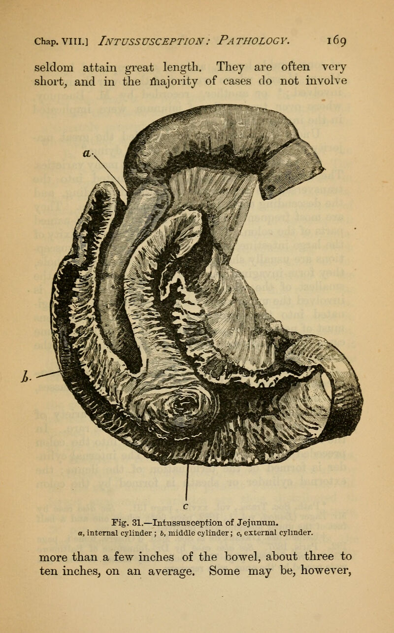 seldom attain great length. They are often very short,, and in the fliajority of cases do not involve Fig. 31.—Intussixsceptioii of Jejiinnm. a, internal cylinder ; 6, middle cylinder; c, external cylinder. more than a few inches of the bowel, about three to ten inches, on an average. Some may be, however,