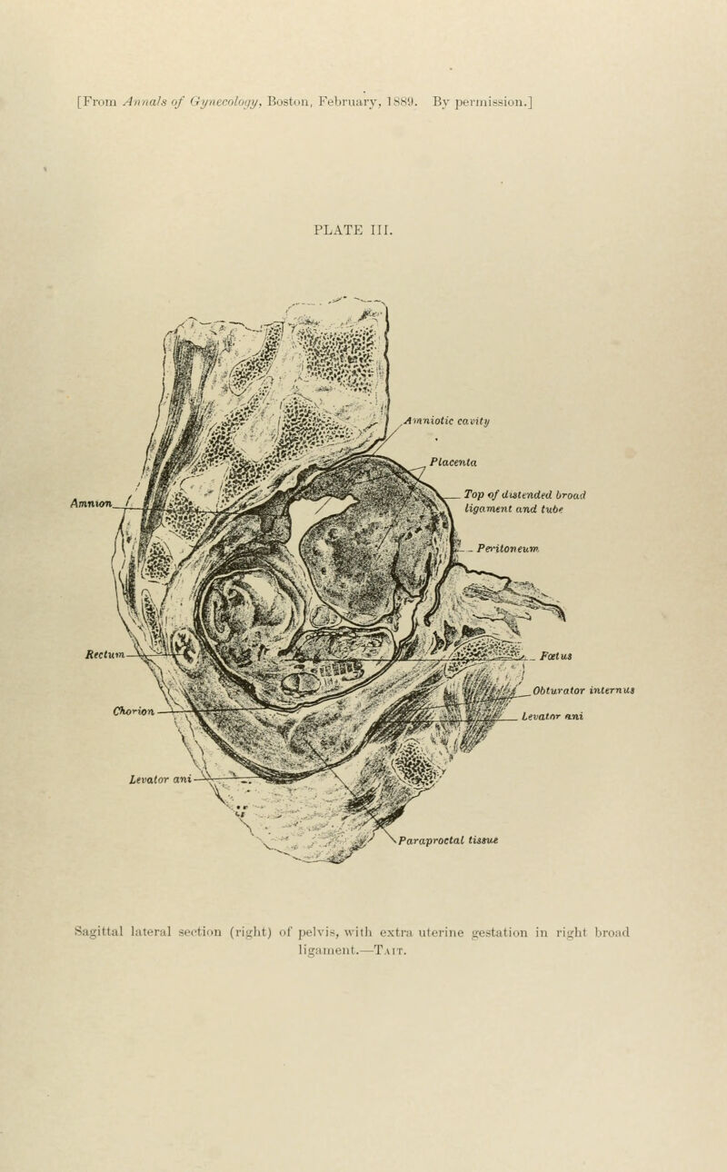 PLATE III. /Imnton /l 7op o/ dutended broad ligarnetit and tub'. Rectum Ckorion Foetus wi£'^'fA. Obturator internua K'Ji'Jf/ ievatnr hmi Paraproctal lissve Sagittal lateral section (rijrht) ol' pelvis, with extra uterine gestation in right broad ligament.—T.mt.