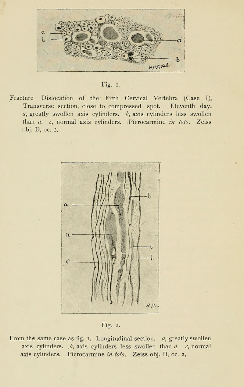 —a] l+.H.T. <a. Fig. I. Fracture Dislocation of the Fifth Cervical Vertebra (Case I). Transverse section, close to compressed spot. Eleventh day. a, greatly swollen axis cylinders, d, axis cylinders less swollen than a. c, normal axis cylinders. Picrocarmine /u toto. Zeiss obj. D, oc. 2. ! a //.>/.; Fig. 2. From the same case as fig. i. Longitudinal section, a, greatly swollen axis cylinders, b, axis cylinders less swollen than a. c, normal axis cylinders. Picrocarmine in toto. Zeiss obj. D, oc. 2.