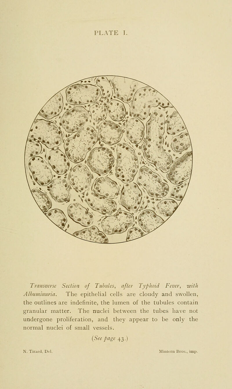 PLATE I. Transverse Section of Tubules, after Typhoid Fever, with Albuminuria. The epithelial cells are cloudy and swollen, the outlines are indefinite, the lumen of the tubules contain granular matter. The nuclei between the tubes have not undergone proliferation, and they appear to be only the normal nuclei of small vessels. {Seepage 43,) N. Tirard, Del. Miiitern Bros., imp.
