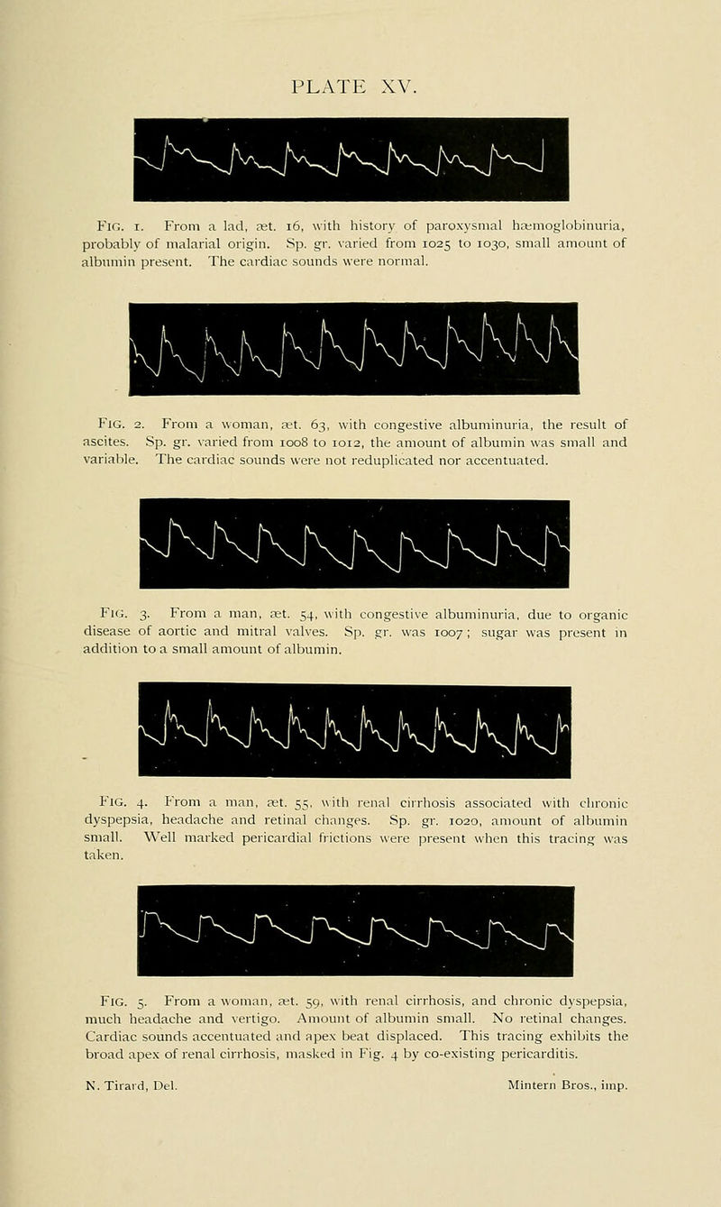 Fig. I. From a lad, net. i6, with history of paroxysmal htKmoglobinm-ia, probably of malarial origin. Sp. gr. varied from 1025 to 1030, small amount of albumin present. The cardiac sounds were normal. Fig. 2. From a woman, xt. 63, with congestive albuminuria, the result of ascites. Sp. gr. varied from 1008 to 1012, the amount of albumin was small and variable. The cardiac sounds were not reduplicated nor accentuated. Fig. 3. From a man, ret. 54, with congestive albuminuria, due to organic disease of aortic and mitral valves. Sp. gr. was 1007 ; sugar was present in addition to a small amount of albumin. Fig. 4. From a man, jet. 55, with renal cirrhosis associated with chronic dyspepsia, headache and retinal changes. Sp. gr. 1020, amount of albumin small. Well marked pericardial frictions were present when this tracing was taken. Fig. 5. From a woman, ret. 59, with renal cirrhosis, and chronic dyspepsia, much headache and vertigo. Amount of albumin small. No retinal changes. Cardiac sounds accentuated and apex beat displaced. This tracing exhibits the broad apex of renal cirrhosis, masked in Fig. 4 by co-existing pericarditis. N. Tirard, Del. Mintern Bros., imp.