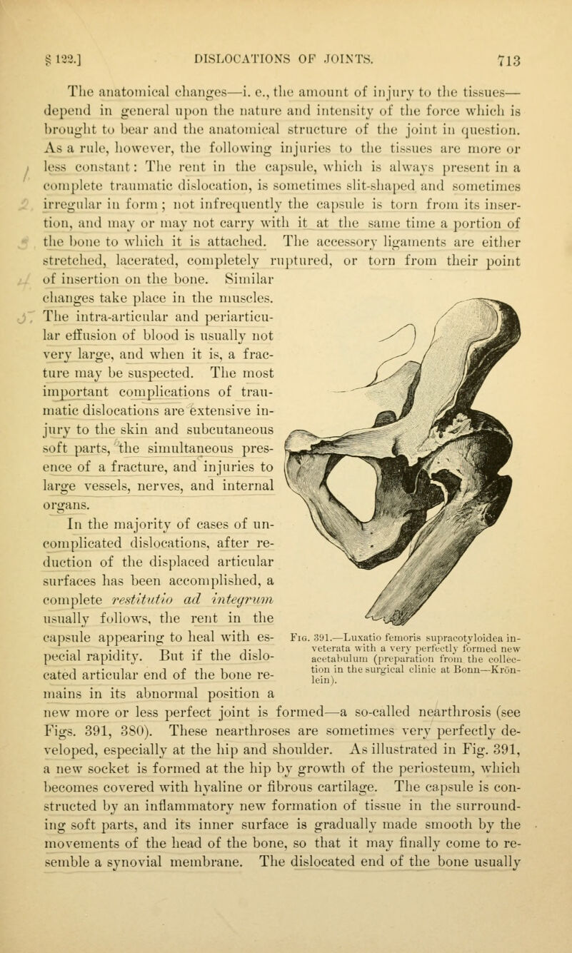 The anatomical changes—i. e., the amount of injury to the tissues— depend in general upon the nature and intensity of the force which is hrought to bear and the anatomical structure of the joint in question. As a rule, however, the following injuries to the tissues are more or less constant: The rent in the capsule, which is always present in a complete traumatic dislocation, is sometimes slit-shaped and sometimes irregular in form ; not infre<piently the capsule is torn from its inser- tion, and may or may not carry with it at the same time a portion of the bone to which it is attached. The accessory ligaments are either stretched, lacerated, completely ruptured, or torn from their point of insertion on the bone. Similar ciianges take place in the muscles. The intra-articular and periarticu- lar effusion of blood is usually not ver}' large, and when it is, a frac- ture may be suspected. The most important complications of trau- matic dislocations are extensive in- jury to the skin and subcutaneous so^t parts, '\he simultaneous pres- ence of a fracture, and injuries to large vessels, nerves, and internal organs. In the majority of cases of un- complicated dislocations, after re- duction of the displaced articular surfaces has been accomplished, a complete restitutio ad i7iteg7'um usually follows, the rent in the capsule appearing to heal with es- pecial rapidity. But if the dislo- cated articular end of the bone re- mains in its abnormal position a new more or less perfect joint is formed—a so-called nearthrosis (see Figs. 391, 380). These nearthroses are sometimes very perfectly de- veloped, especially at the hip and shonlder. As ilhistrated in Fig. 391, a new socket is formed at the hip by growth of the periosteum, which becomes covered with hyaline or fibrous cartilage. The capsule is con- structed by an inflammatory new formation of tissue in the surround- ing soft parts, and its inner surface is gradually made smooth by the movements of the head of the bone, so that it may finally come to re- semble a synovial membrane. The dislocated end of the bone usually Fig. 391.—Luxatio femoris supracotyloidca in- veterata with a very pert't^etly formed new acetabulum (prei>aration from the collec- tion in the surgical clinic at Bonn—KrOn- lein).