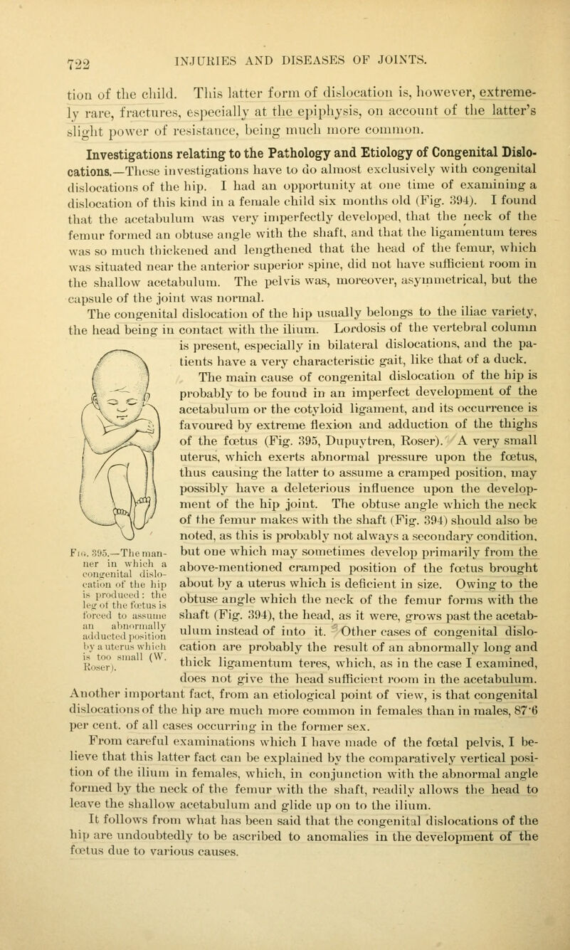 tion of the child. This latter form of dislocation is, however, extreme- ly rare, fractures, especially at the epiphysis, on account of the latter's slight power of resistance, being much more common. Investigations relating to the Pathology and Etiology of Congenital Dislo- cations.—These investigations have to do almost exclusively with congenital (Uslocations of the hip. I had an opportunity at one time of examining a dislocation of this kind in a female child six months old (Fig. 394). I found that the acetahulum was very imperfectly developed, that the neck of the femur formed an obtuse angle with the shaft, and that the ligamentum teres was so much thickened and lengthened that the head of the femur, which was situated near the anterior superior spine, did not have sufficient room in the shallow acetabulum. The pelvis was, moreover, asymmetrical, but the capsule of the joint was normal. The congenital dislocation of the hip usually Ijelongs to the iliac variety, the head being in contact with the ilium. Lordosis of the vertebral colunm is present, especially in bilateral dislocations, and the pa- tients have a very characteriscic gait, like that of a duck. The main cause of congenital dislocation of the hip is probably to be found in an imperfect development of the acetabulum or the cotyloid ligament, and its occurrence is favoured by extreme flexion and adduction of the thighs of the foetus (Fig. 395, Dupuytren, Roser). A very small uterus, which exerts abnormal pressure upon the foetus, thus causing the latter to assume a cramped position, may possibly have a deleterious influence upon the develop- ment of the hip joint. The obtuse angle which the neck of the femur makes with the shaft (Fig-. 394) should also be noted, as this is probably not always a secondary condition, but one which may sometimes develop primarily from the above-mentioned cramped position of the foetus brought about by a uterus which is deficient in size. Owing to the obtuse angle which the neck of the femur forms with the shaft (Fig-. 394), the head, as it were, grows past the acetab- ulum instead of into it. Other cases of congenital dislo- cation are probably the result of an abnormally long and thick ligamentum teres, which, as in the case I examined, does not give the head sufficient room in the acetabulum. Another important fact, from an etiological point of view, is that congenital dislocations of the hip are m^^ch more common in females than in males, 876 per cent, of all cases occurring in the former sex. From careful examinations which I have made of the foetal pelvis, I be- lieve that this latter fact can be explained by the comparatively vertical posi- tion of the ilium in females, which, in conjunction with the abnormal angle formed by the neck of the femur with the shaft, readily allows the head to leave the shallow acetabulum and ghde up on to the ilium. It follows from what has been said that the congenital dislocations of the hip are undoubtedly to be ascribed to anomalies in the development of the foetus due to various causes. Fi(i. 395.—The man- ner in which a eontreniUil dislo- cation <it' the liip is prodiK'cd: tlie leg ot the f'(jetus is forced to assume an abnormally adducted position l«y a uterus which is too small (W. Roserj.