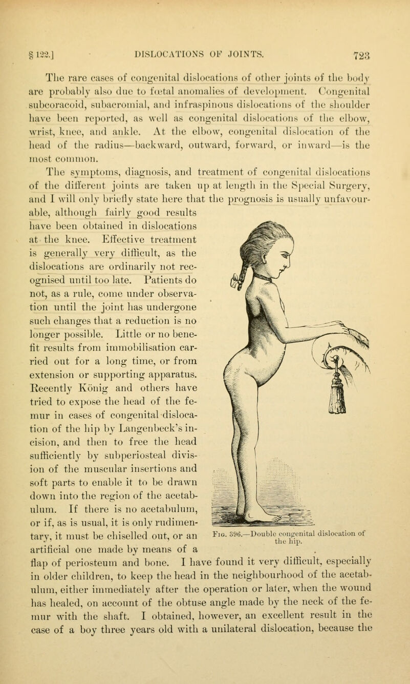 The rare eases of eongenital dislocations of otlier joints of the body are probably also due to fcetal anomalies of development. Congenital subcoracoid, subacromial, and infraspinous dislocations of the shoulder have been reported, as well as congenital dislocations of the elbow, wrist, knee, and ankle. At the elbow, congenital dislocation of the head of the radius—backward, outward, forward, or inward—is the most Common. The symptoms, diagnosis, and treatment of congenital dislocations of the dilferent joints are taken up at length in the Special Surgery, and 1 will only brielly state here that the prognosis is usually unfavour- able, although fairly good results have been obtained in dislocations at the knee. Effective treatment is generally very difficult, as the dislocations are ordinarily not rec- ognised until too late. Patients do not, as a rule, come under observa- tion until the joint has undergone such changes that a reduction is no longer possible. Little or no bene- fit results from innnobilisation car- ried out for a long time, or from extension or supporting apparatus. Recently Konig and others have tried to expose the head of the fe- mur in cases of congenital disloca- tion of the hip by Langenbeck's in- cision, and then to free the head sufficiently by subperiosteal divis- ion of the muscular insei'tions and soft parts to enable it to be drawn down into the region of the acetab- ulum. If there is no acetabulum, or if, as is usual, it is only rudimen- tary, it must be chiselled out, or an artificial one made by means of a flap of periosteum and bone. I have found it very difficult, especially in older children, to keep the head in the neighbourhood of the acetab- ulum, either immediately after the operation or later, when the wound has healed, on account of the obtuse angle made by the neck of the fe- mur with the shaft. I obtained, however, an excellent result in the case of a boy three years old with a unilateral dislocation, because the Fig. 396. -Double eoiiifenital dislocation of the hip.