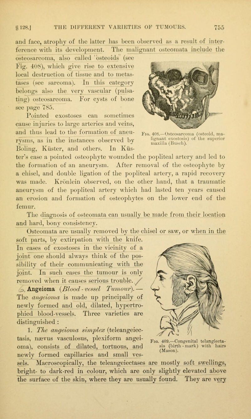 Fig. 408.—Osteosareonia (osteoid, ma- lignant exostosis) of the superior maxilla (Busch). and ftice, atrophy of the lattur has been observed as a result of inter- ference witli its development. The malignant osteoinata include the osteosarcoma, also called osteoids (see Fig. 408), which give rise to extensive local destruction of tissue and to metas- tases (see sarcoma). In this category belongs also the very vascular (pulsa- ting) osteosarcoma. For cysts of bone see page 785. Pointed exostoses can sometimes cause injuries to large arteries and veins, and thus lead to the formation of aneu- rysms, as in the instances observed by Boling, Klister, and others. In Kiis- ter's case a pointed osteophyte wounded the popliteal artery and led to the formation of an aneurysm. After removal of the osteophyte by a chisel, and double ligation of the popliteal artery, a rapid recovery was made. Kronlein observed, on the other hand, that a traumatic aneurysm of the popliteal artery which had lasted ten years caused an erosion and formation of osteophytes on the lower end of the femur. The diagnosis of osteomata can usually be made from their location and hard, bony consistency. Osteomata are usually removed by the chisel or saw, or when in the soft parts, by extirpation with the knife. In cases of exostoses in the vicinity of a joint one should always think of the pos- sibility of their communicating with the joint. In such cases the tumour is only removed wlien it causes serious trouble. / _>, Angeioma {Blood - vessel Tumour). — The angeiorna is made up principally of newly formed and old, dilated, hypertro- phied blood-vessels. Three varieties are distinguished : 1. The angeiorna simplex (teleangeiec- tasis, nsevus vasculosus, plexiform angei- oma), consists of dilated, tortuous, and newly formed capillaries and small ves- sels. Macroscopically, the teleangeiectases are mostly soft swellings, bright- to dark-red in colour, which are only slightly elevated above the surface of the skin, where they are usually found. They are very Fig. 409.—Congenital telangiecta- sis (birtli - mark) with hairs (Masion).