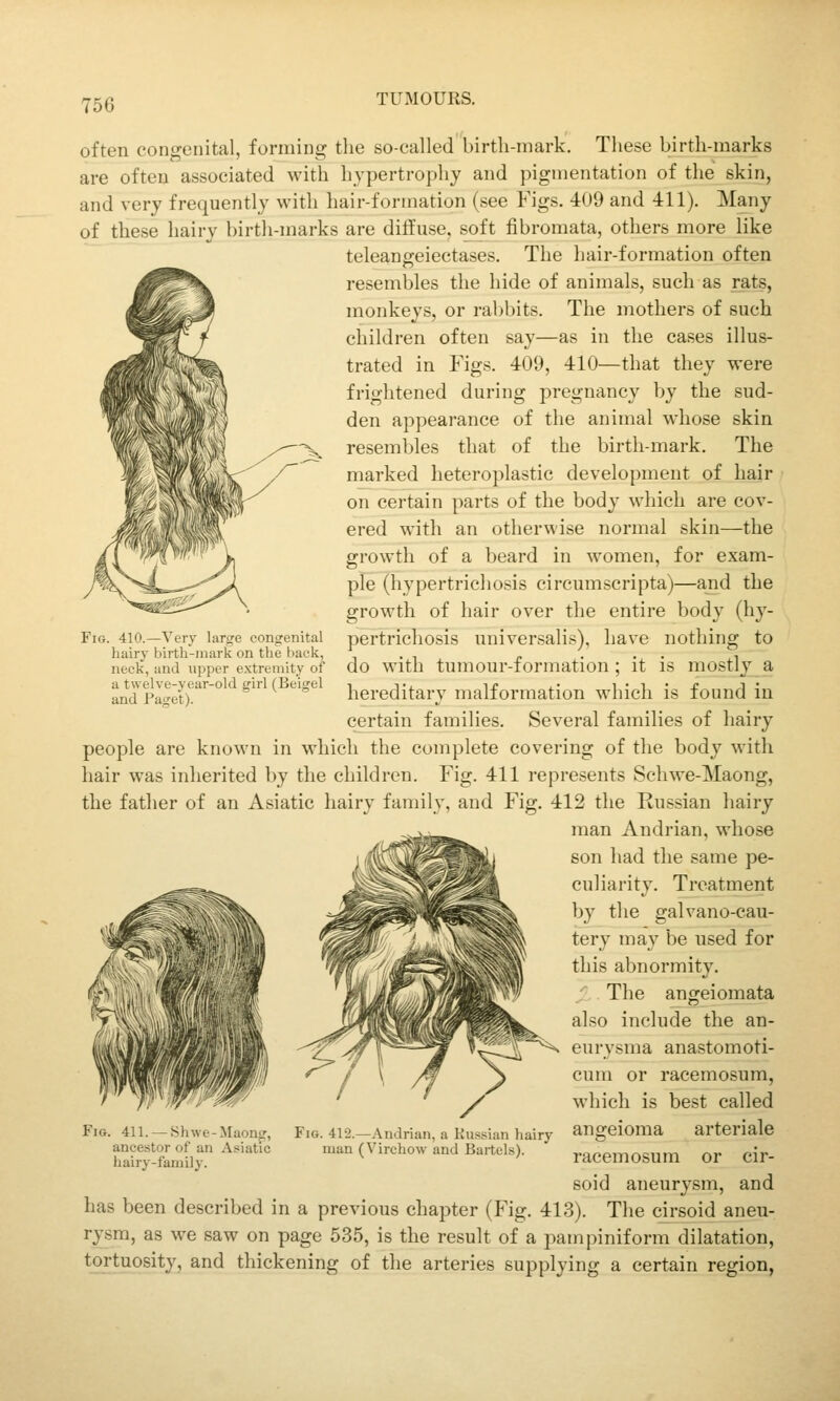 often congenital, forming the so-called'birth-mark. These birth-marks are often associated with hypertrophy and pigmentation of the skin, and very frequently with hair-formation (see Figs. 409 and 411). Many of these hairy birth-marks are diffuse, soft fibromata, others more like teleanffeiectases. The hair-formation often resembles the hide of animals, such as rats, monkeys, or rabbits. The mothers of such children often say—as in the cases illus- trated in Figs. 409, 410—that they were frightened during pregnancy by the sud- den appearance of the animal whose skin resembles that of the birth-mark. The marked heteroplastic development of hair on certain parts of the body which are cov- ered with an otherwise normal skin—the growth of a beard in women, for exam- ple ^hypertrichosis circumscripta)—and the growth of hair over the entire body (hy- pertrichosis universalis), have nothing to do with tumour-formation; it is mostly a hereditary malformation which is found in certain families. Several families of hairy people are known in which the complete covering of the body with hair was inherited by the children. Fig. 411 represents Schwe-Maong, the father of an Asiatic hairy family, and Fig. 412 the Russian hairy man Andrian, whose son had the same pe- culiarity. Treatment by the galvano-cau- tery may be used for this abnormity. Kr:■^!i',ll\l■lMraifflHi m Mm^,,jln!lllKmW 'The angeiomata also include the an- eurvsma anastomoti- FiG. 410.—Very large congenital hairy birth-mark on the back, neck, and upper extremity of a twelve-year-old girl (Beigel and Paget). Fig. 411. —Shwe-Maonjr, ancestor of an Asiatic hairy-family. Fig. 412.—Andrian, a Russian hairy man (Virchow and Bartels). cum or racemosum, which is best called angeioma arteriale racemosum or cir- soid aneurysm, and has been described in a previous chapter (Fig. 413). The cirsoid aneu- rysm, as we saw on page 535, is the result of a pampiniform dilatation, tortuosity, and thickening of the arteries supplying a certain region,