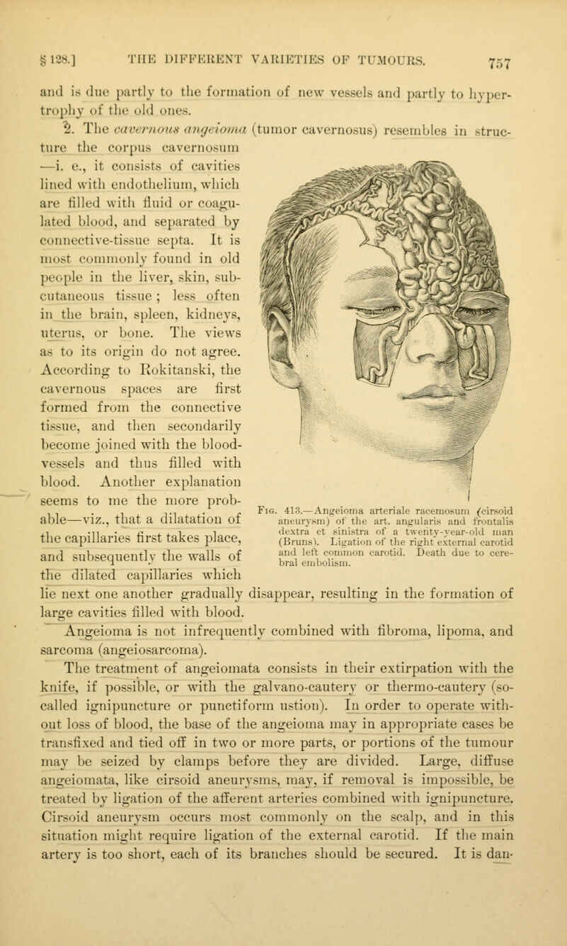 and is due partly to the formation of new vessels and partly to liyper- tr(»i)hy of the old ones. ^. The cavernous migeioma (tumor cavernosus) resembles in struc- ture the corpus cavernosum •—i. e., it consists of cavities lined with endothelium, which are filled with lluid or coagu- lated blood, and separated by connective-tissue septa. It is most commonly found in old people in the liver, skin, sub- cutaneous tissue; less often in the brain, spleen, kidneys, u_terus, or bone. The views as to its origin do not agree. According to Eokitanski, the cavernous spaces are first formed from the connective tissue, and then secondarily become joined with the blood- vessels and thus filled with blood. Another explanation seems to me the more prob- able—viz., that a dilatation of the capillaries first takes place, and subsequently the walls of the dilated capillaries which he next one another gradually disappear, resulting in the formation of large cavities filled with blood. Angeioma is not infrequently combined with fibroma, lipoma, and sarcoma (angeiosarcorna). The treatment of angeiomata consists in their extirpation with the knife, if possible, or with the galvano-cautery or thermo-cautery (so- called ignipuncture or punctiform ustion). In order to operate with- out loss of blood, the base of the angeioma may in appropriate cases be transfixed and tied off in two or more parts, or portions of the tumour may be seized by clamps before they are divided. Large, diffuse angeiomata, like cirsoid aneurysms, ma}^, if removal is impossible, be treated by ligation of the afferent arteries combined with ignipuncture. Cirsoid aneurysm occurs most commonly on the scalp, and in this situation might require ligation of the external carotid. If the main artery is too short, each of its branches should be secured. It is dan- Fig. 41.3.—Angeioma arteriale raceraosuni (cirsoid aneurysm) of the art. angularis and frontalis dextra et sinistra of a twenty-year-old man (Bruns'l. Ligation of the right external carotid and left common carotid. Death due to cere- bral embolism.