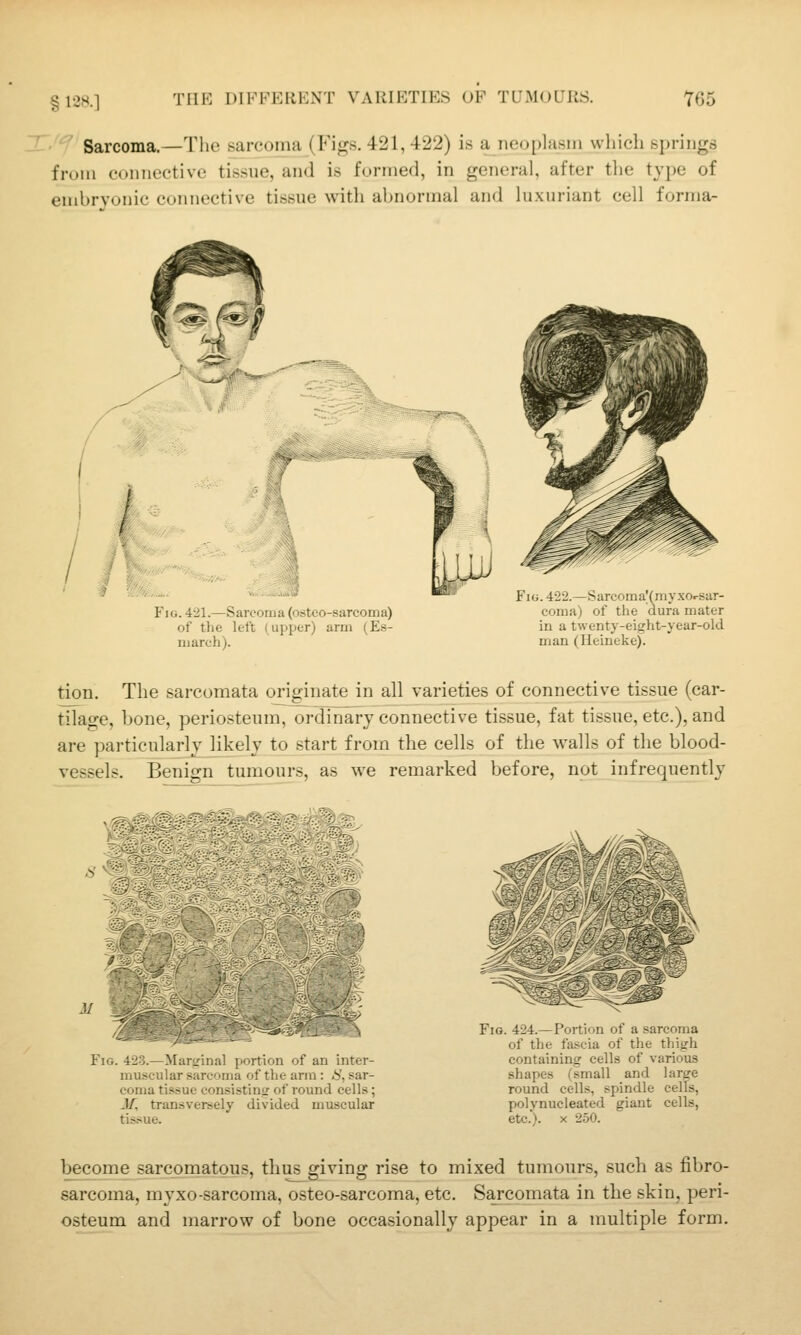 12H.] ^'^ Sarcoma.—The sarcoma (Figs. 421, 422) is a neoplasm wlileh springs from connective tissue, and is formed, in general, after tlie type of embryonic connective tissue with abnormal and luxuriant cell forma- FiG. 421.—Sarcoma (osteo-sarcoma) of the left (upper) arm (Es- luarch). Fig. 422.—SarcomaVmyxc-sar- coma) of the dura mater in a twenty-eight-year-old man (Ileineke). tion. The sarcomata originate in all varieties of connective tissue (car- tilage, bone, periosteum, ordinary connective tissue, fat tissue, etc.), and are particularly likely to start from the cells of the walls of tlie blood- vessels. Benign tumours, as we remarked before, not infrequently Fig. 423.— ■; _ i ortion of an inter- muscular sarcjiiia of the arm : <S', sar- coma tis.sue consistinsr of round cells; M, transversely divided muscular tissue. Fig. 424.—Portion of a sarcoma of the fascia of the thigh containing cells of various shapes (small and large round cells, spindle cells, polynucleated giant cells, etc.). X 250. become sarcomatous, thus giving rise to mixed tumours, such as fibro- sarcoma, myxo-sarcoma, osteo-sarcoma, etc. Sarcomata in the skin, peri- osteum and marrow of bone occasionally appear in a multiple form.