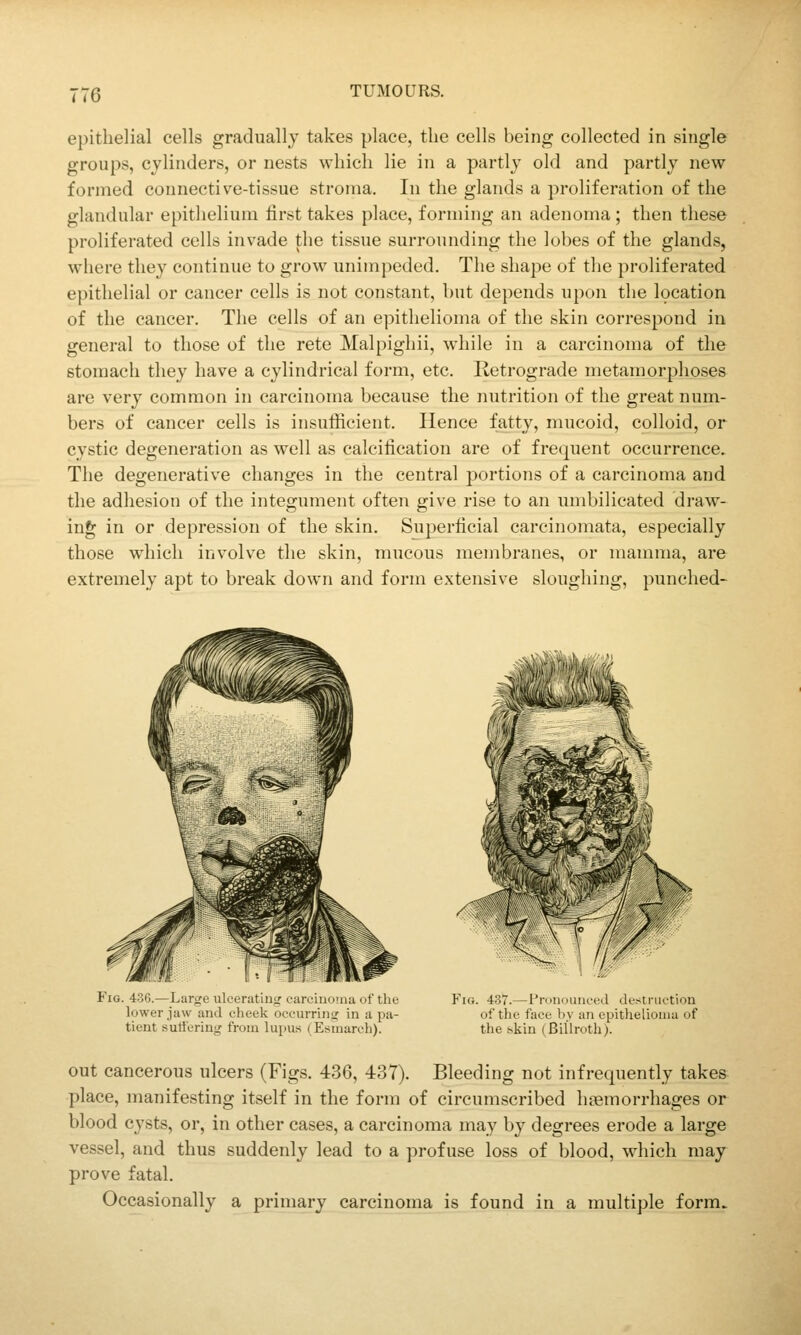 re epithelial cells gradually takes place, tlie cells being collected in single groups, cylinders, or nests which lie in a partly old and partly new formed connective-tissue stroma. In the glands a proliferation of the glandular epithelium first takes place, forming an adenoma ; then these proliferated cells invade the tissue surrounding the lobes of the glands, where they continue to grow unimpeded. The shape of the proliferated epithelial or cancer cells is not constant, but depends upon the l9cation of the cancer. The cells of an epithelioma of the skin correspond in general to those of the rete Malpighii, while in a carcinoma of the stomach they have a cylindrical form, etc. Retrograde metamorphoses are very common in carcinoma because the nutrition of the great num- bers of cancer cells is insufficient. Hence fatty, mucoid, colloid, or cystic degeneration as well as calcification are of frequent occurrence. The degenerative changes in the central portions of a carcinoma and the adhesion of the integument often give rise to an umbilicated draw- ing in or depression of the skin. Superficial carcinomata, especially those which involve the skin, mucous membranes, or mamma, are extremely apt to break down and form extensive sloughing, punched- Fig. 436.—Large ulcerating careiuouia of tliu lower jaw and cheek occurring in a pa- tient sutt'eriug frona lupus (Esinareh). Fig. 437.—Pronounced destruction of the face by an epithelioma of the skin (Billroth). out cancerous ulcers (Figs. 436, 437). Bleeding not infrequently takes place, manifesting itself in the form of circumscribed hiemorrhages or blood cysts, or, in other cases, a carcinoma may by degrees erode a large vessel, and thus suddenly lead to a profuse loss of blood, which may prove fatal. Occasionally a primary carcinoma is found in a multiple form.