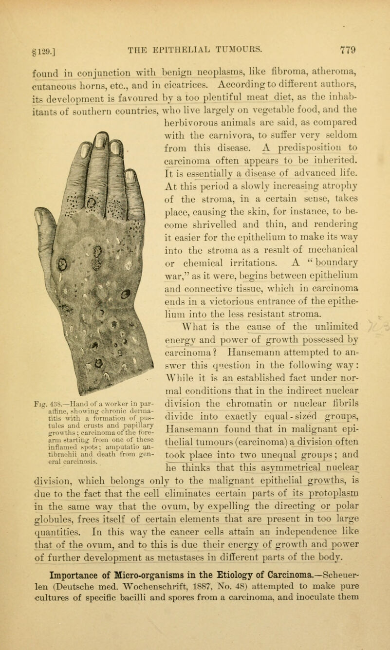 found in conjunction with benign neoplasms, like fibroma, atheroma, cutaneous horns, etc., and in cicatrices. According to different authors, its development is favoured by a too plentiful meat diet, as the inhab- itants of southern countries, who live largely on vegetable food, and the herbivorous animals are said, as compared with the carnivora, to suffer very seldom from this disease. A predisposition to carcinoma often appears to be inherited. It is essentially a disease of advanced life. At this period a slowly increasing atrophy of the stroma, in a certain sense, takes place, causing the skin, for instance, to be- come shrivelled and thin, and rendering it easier for the epithelium to make its way into the stroma as a result of mechanical or chemical irritations. A  boundary war, as it were, begins between epithelium and connective tissue, which in carcinoma ends in a victorious entrance of the epithe- lium into the less resistant stroma. ■ ^' What is the cause of the unlimited ; f energy and power of growth possessed by P carcinoma? Hansemann attempted to an- swer this question in the following way: .: v AVhile it is an established fact under nor- mal conditions that in the indirect nuclear Fig. 438.—Hand of a worker in par- division the chromatin or nuclcar fibrils artine. showing chronic derma- t . ^ • , ,^ i'-j titis with a formation of pus- divide mto exactly cqual - sized groups, growths;clSma'of^hSS Hansemaun found that in malignant epi- arm starting from one of these thelial tumours (carciuoma) a division often inflamed spots; amputatio an- ^ ■' — tibrachii and death from gen- took place into two Unequal groups; and eral carcinosis. . . . he thinks that this asymmetrical nuclear division, which belongs only to the malignant epithelial growths, is due to the fact that the cell eliminates certain parts of its protoplasm in the same way that the ovum, by expelling the directing or polar globules, frees itself of certain elements that are present in too large quantities. In this way the cancer cells attain an independence like that of the ovum, and to this is due their energy of growth and power of further development as metastases in different parts of the body. Importance of Micro-organisms in the Etiology of Carcinoma.—Scheuer- len (Deutsche med. Wochenschi-ift, 1887, No. 48) attempted to make pure cultures of specific bacilli and spores from a carcinoma, and inoculate them