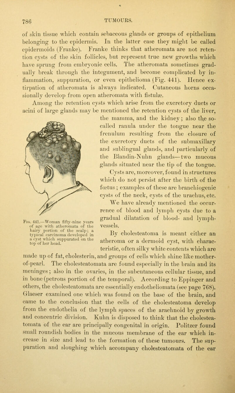 of skin tissue wliicli contain sebaceous glands or groups of epithelium belonging to the epidermis. In the latter case they might be called epidermoids (Franke). Franke thinks that atheromata are not reten- tion cysts of the skin follicles, but represent true new growths which have sprung from embryonic cells. The atheromata sometimes grad- ually break through the integument, and become complicated by in- flammation, suppuration, or even epithelioma (Fig. 441). Hence ex- tirpation of atheromata is always indicated. Cutaneous horns occa- sionally develop from open atheromata with fistulse. Among the retention cysts which arise from the excretory ducts or acini of large glands may be mentioned the retention cysts of the liver, the mamma, and the kidney; also th,e so- called ranula under the tongue near the frenulum resulting from the closure of the excretory ducts of the submaxillary and sublingual glands, and particularly of the Blandin-Nuhn glands—two mucous glands situated near the tip of the tongue. Cysts are, moreover, found in structures which do not persist after the birth of the foetus ; examples of these are branchiogenic cysts of the neck, cysts of the urachus, etc. We have already mentioned the occur- rence of blood and lymph cysts due to a gradual dilatation of blood- and lymph- vessels. By cholesteatoma is meant either an atheroma or a dermoid cyst, with charac- teristic, often silky white contents which are made up of fat, cholesterin, and groups of cells which shine like mother- of-pearl. The cholesteatomata are found especially in the brain and its meninges; also in the ovaries, in the subcutaneous cellular tissue, and in bone (petrous portion of the temporal). According to Eppinger and others, the cholesteatomata are essentially endotheliomata (see page 768). Glaeser examined one which was found on the base of the brain, and came to the conclusion that the cells of the cholesteatoma develop from the endothelia of the lymph spaces of the arachnoid by growth and concentric division. Kuhn is disposed to think that the cholestea- tomata of the ear are principally congenital in origin. Politzer found small roundish bodies in the mucous membrane of the ear which in- crease in size and lead to the formation of these tumours. The sup- puration and sloughing which accompany cholesteatomata of the ear Fio. 441. Woman fifty-nine years with atheromata of the hairy portion of the scalp; a typical carcinoma developed in a cyst which suppurated on the top of her head.