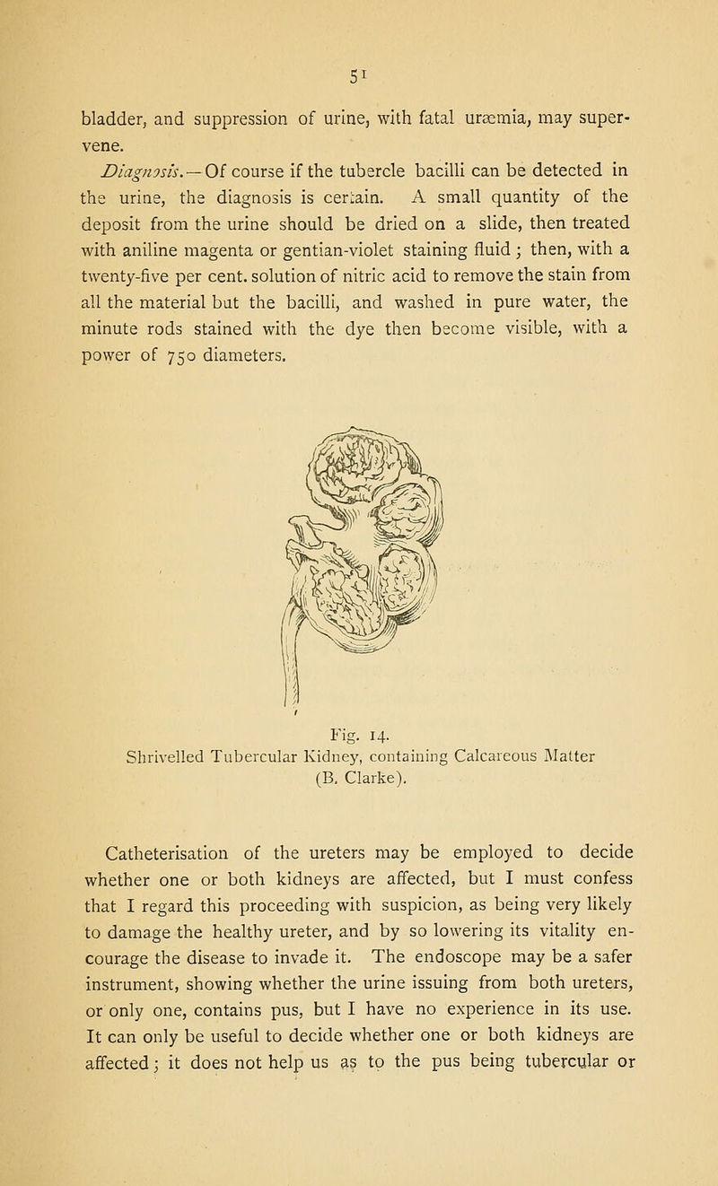 bladder, and suppression of urine, with fatal uraemia, may super- vene. Diagnosis. —Oi course if the tubercle baciUi can be detected in the urine, the diagnosis is certain. A small quantity of the deposit from the urine should be dried on a slide, then treated with aniline magenta or gentian-violet staining fluid ; then, with a twenty-five per cent, solution of nitric acid to remove the stain from all the material but the bacilli, and washed in pure water, the minute rods stained with the dye then become visible, with a power of 750 diameters. Fig. 14. Shrivelled Tubercular Kidney, containing Calcareous flatter (B. Clarke). Catheterisation of the ureters may be employed to decide whether one or both kidneys are affected, but I must confess that I regard this proceeding with suspicion, as being very likely to damage the healthy ureter, and by so lowering its vitality en- courage the disease to invade it. The endoscope may be a safer instrument, showing whether the urine issuing from both ureters, or only one, contains pus, but I have no experience in its use. It can only be useful to decide whether one or both kidneys are affected; it does not help us 9.5 to the pus being tubercular or