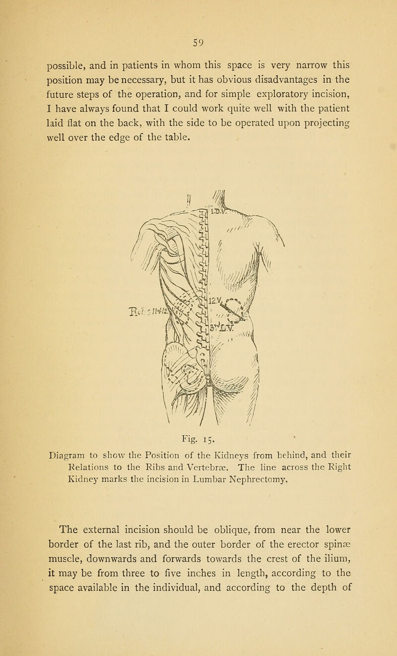 possible, and in patients in whom this space is very narrow this position may be necessary, but it has obvious disadvantages in the future steps of the operation, and for simple exploratory incision, I have always found that I could work quite well with the patient laid flat on the back, with the side to be operated upon projecting well over the edge of the table. Fig. 15. Diagram to show the Position of the Kidneys from behind, and their Kelations to the Ribs and Vertebrae. The line across the Right Kidney marks the incision in Lumbar Nephrectomy. The external incision should be oblique, from near the lower border of the last rib, and the outer border of the erector spinse muscle, downwards and forwards towards the crest of the ilium, it may be from three to five inches in length, according to the space available in the individual, and according to the depth of