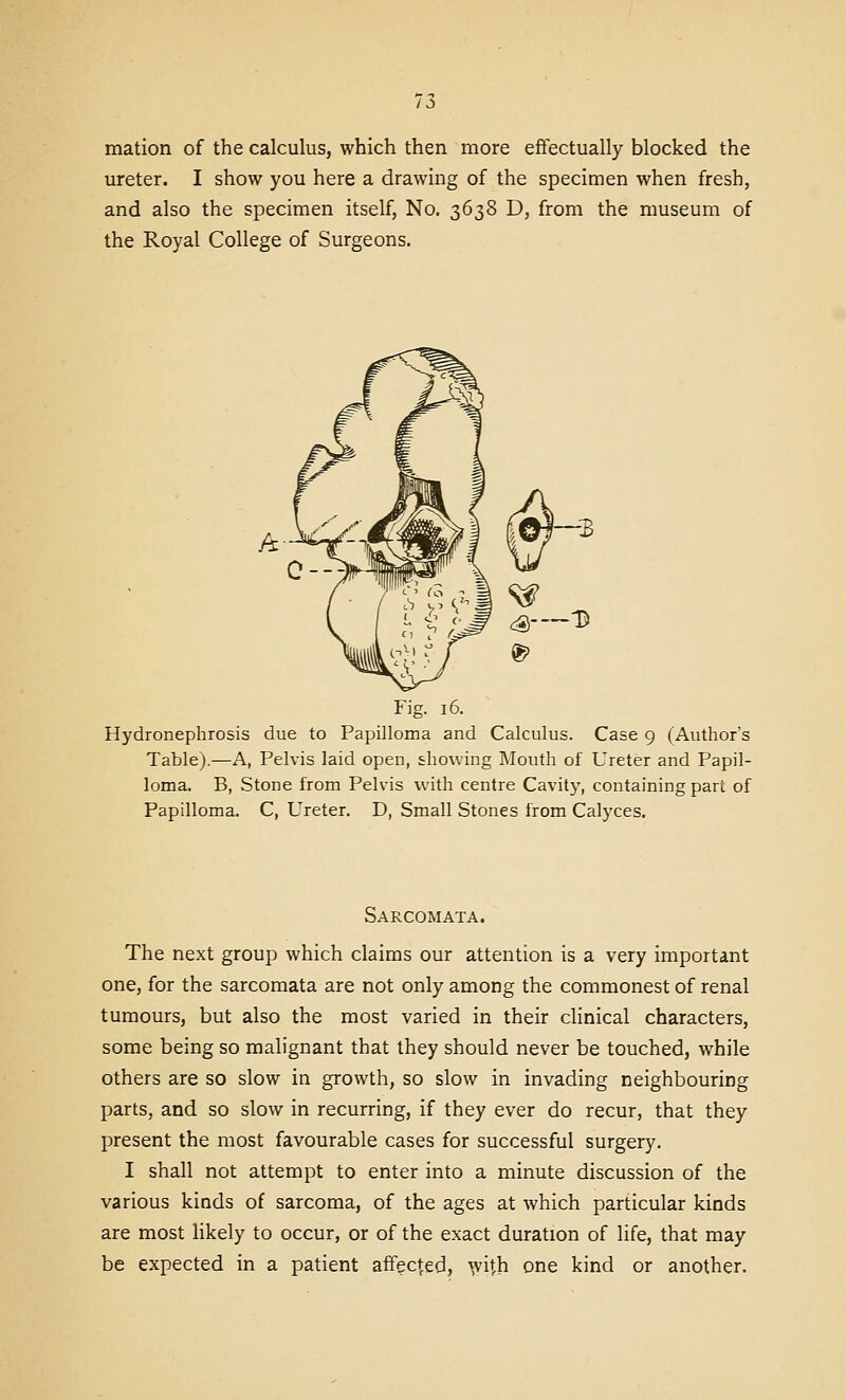mation of the calculus, which then more effectually blocked the ureter. I show you here a drawing of the specimen when fresh, and also the specimen itself, No. 3638 D, from the museum of the Royal College of Surgeons. Fig. 16. Hydronephrosis due to Papilloma and Calculus. Case 9 (Author's Table).—A, Pelvis laid open, showing Mouth of Ureter and Papil- loma. B, Stone from Pelvis with centre Cavity, containing part of Papilloma. C, Ureter. D, Small Stones from Calyces. Sarcomata. The next group which claims our attention is a very important one, for the sarcomata are not only among the commonest of renal tumours, but also the most varied in their clinical characters, some being so malignant that they should never be touched, while others are so slow in growth, so slow in invading neighbouring parts, and so slow in recurring, if they ever do recur, that they present the most favourable cases for successful surgery. I shall not attempt to enter into a minute discussion of the various kinds of sarcoma, of the ages at which particular kinds are most likely to occur, or of the exact duration of life, that may be expected in a patient affected, ^vith one kind or another.