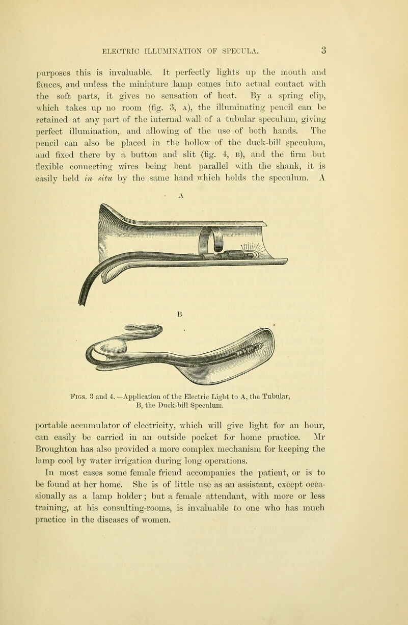 purposes this is invakiable. It perfectly lights up the moutli and fauces, and unless the miniature lamp comes into actual contact with tlie soft parts, it gives no sensation of heat. By a spring clip, Avhich takes up no room (tig. 3, a), the illuminating pencil can be retained at any part of the internal wall of a tubular sj)eculum, giving perfect illumination, and allowing of the use of both hands. The pencil can also be placed in the hollow of the duck-bill speculum, and fixed there by a button and slit (fig. 4, b), and the firm but flexible connecting wires being bent parallel with the shank, it is easily held in situ by the same hand which holds the speculum. A Figs. 3 and 4. —Application of the Electric Light to A, tlie Tubular, B, the Duck-bill Speculum. portable accumulator of electricity, which will give light for an hour, can easily be carried in an outside jiocket for home practice. Mr Broughton has also provided a more complex mechanism for keeping the lamp cool by water iiTigatioii during long ojDerations. In most cases some female friend accompanies the patient, or is to be found at her home. She is of little \ise as an assistant, except occa- sionally as a lamp holder; but a female attendant, with more or less training, at liis consulting-rooms, is invaluable to one who has mucli practice in the diseases of women.
