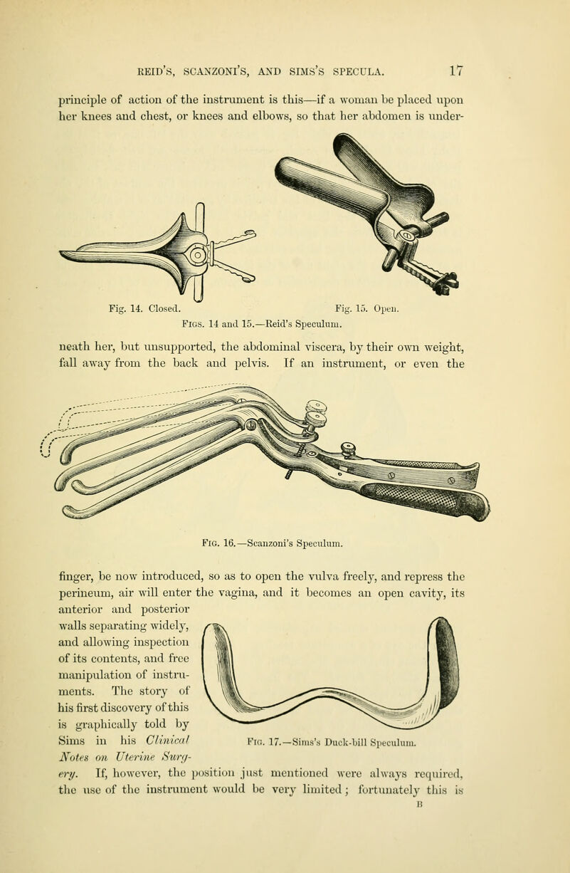 principle of action of the instiaiment is this—if a woman be placed upon hex* knees and chest, or knees and elbows, so that her abdomen is under- 15. Open. Figs. 14 and 15.—Reid's Speculum. neath hei', but unsupported, the abdominal viscera, by their own w^eight, fall away from the back and pelvis. If an instrument, or even the Fig. 16.—Scanzoni's Speculum. finger, be now introduced, so as to open the vulva freely, and repress the perineum, air will enter the vagina, and it becomes an open cavity, its anterior and posterior walls separating widely, and allowing inspection of its contents, and free manipulation of instru- ments. The story of his first discovery of this is graphically told by Sims in his Clinical Notes on Uterine Surg- ery. If, however, the position just mentioned were always rcciuired, the use of the instrument would be very limited; fortunately this is Fig. 17.—Sinis'.s Duck-bill Speculum.