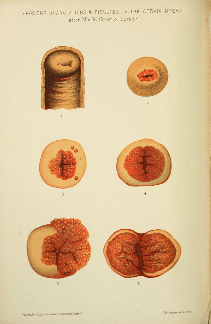 EROSIONS,GRANULATIONS & FISSURES OF THE CERVIX UTERI after Munde,CrooiiL,8c Savage. Watson, 3ro' U>aafia,s UJi. 0<- Charles StJJirm.'' JWWatSon. dAetllik..