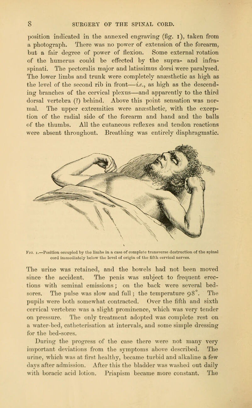 position indicated in the annexed engraving (fig. i), taken from a photograph. There was no power of extension of the forearm, but a fair degree of power of flexion. Some external rotation of the humerus could be effected by the supra- and infra- spinati. The pectoralis major and latissimus dorsi were paralysed. The lower limbs and trunk were completely anaesthetic as high as the level of the second rib in front—i.e., as high as the descend- ing branches of the cervical plexus—and apparently to the third dorsal vertebra (?) behind. Above this point sensation was nor- mal. The upper extremities were anaesthetic, with the excep- tion of the radial side of the forearm and hand and the balls of the thumbs. All the cutaneous reflexes and tendon reactions were absent throughout. Breathing was entirely diaphragmatic. Pio. I.—Position occupied by the limbs in a case of complete transverse destruction of the spinal cord immediately below the level of origin of the fifth cervical nerves. The ui'ine was retained, and the bowels had not been moved since the accident. The penis was subject to frequent erec- tions with seminal emissions; on the back were several bed- sores. The pulse was slow and full; the temperature 98°. Tlie pupils were both somewhat contracted. Over the fifth and sixth cervical vertebra3 was a slight prominence, which was very tender on pressure. The only treatment adopted was complete rest on a water-bed, catheterisation at intervals, and some simple dressing for the bed-sores. During the progress of tlie case there wore not many very important deviations from tlic symptoms above described. The urine, which was at first healthy, became turbid and alkaline a few days after admission. After this the bladder was washed out daily with boracic acid lotion. Priapism became more constant. The