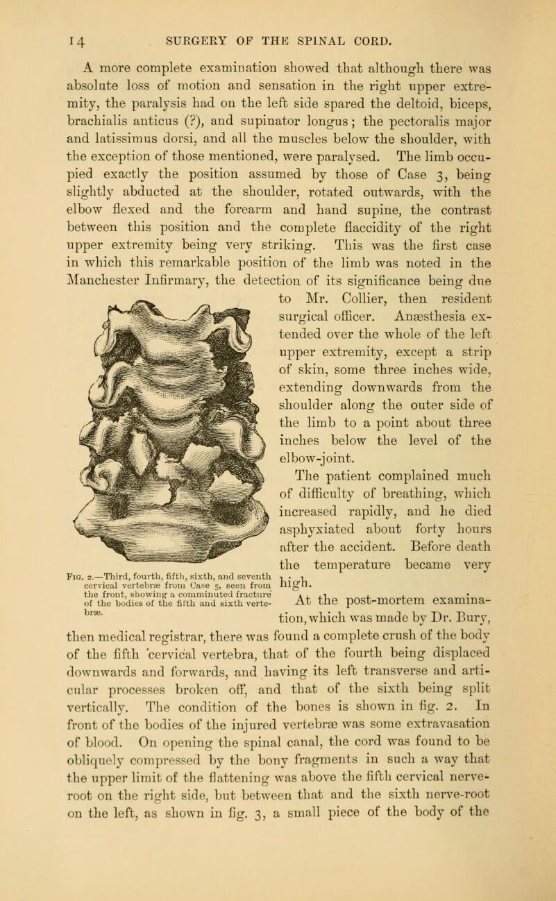 A more complete examination showed that although there was absolute loss of motion and sensation in the right upper extre- mity, the paralysis had on the left side spared the deltoid, biceps, brachialis anticus (?), and supinator longus; the pectoralis major and latissimus dorsi, and all the muscles below the shoulder, with the exception of those mentioned, were paralysed. The limb occu- pied exactly the position assumed by those of Case 3, being slightly abducted at the shoulder, rotated outwards, with the elbow flexed and the forearm and hand supine, the contrast between this position and the complete flaccidity of the right upper extremity being very striking. This was the first case in which this remarkable position of the limb was noted in the Manchester Infirmary, the detection of its significance being due to Mr. Collier, then resident surgical officer. Anassthesia ex- tended over the whole of the left upper extremity, except a strip of skin, some three inches wide, extending downwards from the shoulder along the outer side of the limb to a point about three inches below the level of the elbow-joint. The patient complained much of difficulty of breathing, which increased rapidly, and he died asphyxiated about forty hours after the accident. Before death the temperature became very high. At the post-mortem examina- tion, which was made by Dr. Bury, then medical registrar, there was found a complete crush of tlie body of the fifth 'cervical vertebra, that of the fourth being displaced downwards and forwards, and having its left transverse and arti- cular processes broken off, and that of the sixth being split vertically. The condition of the bones is shown in fig. 2. In front of the bodies of the injured vertebras was some extravasation of blood. On opening the spinal canal, the cord was found to be obliquely compressed by the bony fragments in such a way that the upper limit of the flattening was above the fifth cervical nerve- root on the right side, but between that and the sixth nerve-root on the left, as shown in fig. 3, a small piece of the body of the Fio. 2.—Third, fourth, fiftli, sixth, and seventh cervical vertebra! from Case 5, seen from the front, sliowin^ a comminuted fracture of the bodies of the filth and sixth verte- brae.