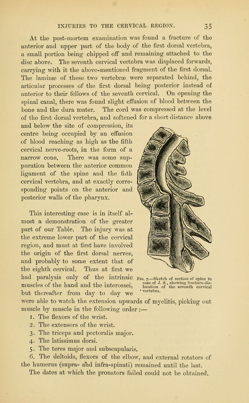 At the post-mortem examination was found a fracture of the anterior and upper part of the body of the first dorsal verteljra, a small portion being chipped off and remaining attached to the disc above. The seventh cervical vertebra was displaced forwards, carrying with it the above-mentioned fragment of the first dorsal. The laminas of these two vertebree were separated behind, the articular processes of the first dorsal being posterior instead of anterior to their fellows of the seventh cervical. On opening the spinal canal, there was found slight effusion of blood between the bone and the dura mater. The cord was compressed at the level of the first dorsal vertebra, and softened for a short distance above and below the site of compression, its centre being occupied by an effusion of blood reaching as high as the fifth cervical nerve-roots, in the form of a narrow cone. There was some sup- puration between the anterior common ligament of the spine and the fiith cervical vertebra, and at exactly corre- sponding points on the anterior and posterior walls of the pharynx. Sketch of section of spine in case of J. S., showing fracture-dis- location of the seventh cervical vertebra. This interesting case is in itself aL most a demonstration of the greater part of our Table. The injury was at the extreme lower part of the cervical region, and must at first have involved the origin of the first dorsal nerves, and probably to some extent that of the eighth cervical. Thus at first we had paralysis only of the intrinsic fio. 7 muscles of the hand and the interossei, but thereafter from day to day we were able to watch the extension upwards of myelitis, picking out muscle by muscle in the following order :— I. The flexors of the wrist. The extensors of the wrist. The triceps and pectoralis major. The latissimus dorsi. The teres major and subscapularis. the humerus (supra- and infra-spinati) remained until the last. The dates at which the pronators failed could not be obtained. 2. 3- 4- 5-