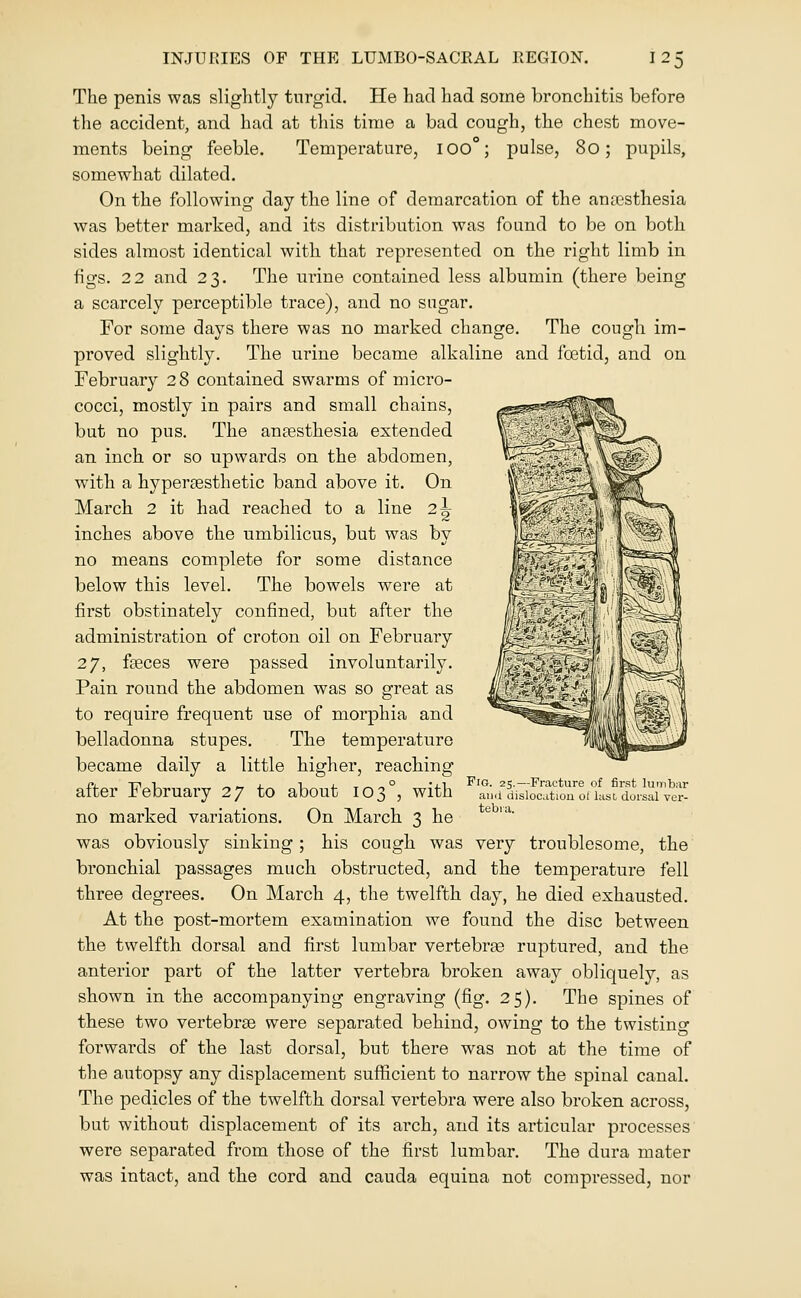 The penis was slightly turgid. He had had some bronchitis before the accident, and had at this time a bad cough, the chest move- ments being feeble. Temperature, 100°; pulse, 8o; pupils, somewhat dilated. On the following day the line of demarcation of the antcsthesia was better marked, and its distribution was found to be on both sides almost identical with that represented on the right limb in figs. 2 2 and 23. The urine contained less albumin (there being a scarcely perceptible trace), and no sugar. For some days there was no marked change. The cough im- proved slightly. The urine became alkaline and foetid, and on February 28 contained swarms of micro- cocci, mostly in pairs and small chains, but no pus. The anaesthesia extended an inch or so upwards on the abdomen, with a hypergesthetic band above it. On March 2 it had reached to a line 2^ inches above the umbilicus, but was by no means complete for some distance below this level. The bowels were at first obstinately confined, but after the administration of croton oil on February 27, fseces were passed involuntarily. Pain round the abdomen was so great as to require frequent use of morphia and belladonna stupes. The temperature became daily a little higher, reaching after February 27 to about 103°, with no marked variations. On March 3 he was obviously sinking; his cough was very troublesome, the bronchial passages much obstructed, and the temperature fell three degrees. On March 4, the twelfth day, he died exhausted. At the post-mortem examination we found the disc between the twelfth dorsal and first lumbar vertebrje ruptured, and the anterior part of the latter vertebra broken away obliquely, as shown in the accompanying engraving (fig. 25). The spines of these two vertebrae were separated behind, owing to the twistino- forwards of the last dorsal, but there was not at the time of the autopsy any displacement sufficient to narrow the spinal canal. The pedicles of the twelfth dorsal vertebi'a were also broken across, but without displacement of its arch, and its articular processes were separated from those of the first lumbar. The dura mater was intact, and the cord and cauda equina not compressed, nor Fig. 25.—Fracture of first lumbar aii(i dislocation ot last dorsal ver- tebra.