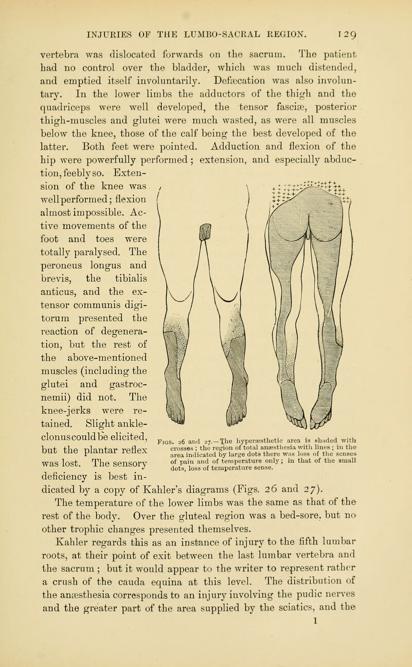 vertebra was dislocated forwards on tlie sacrum. The patient had no control over tlie bladder, which was much distended, and emptied itself involuntarily. Deftecation was also involun- tary. In the lower limbs the adductors of the thicrh and tlie quadriceps were well developed, the tensor fascia, posterior thigh-muscles and glutei were much wasted, as were all muscles below the knee, those of the calf being the best developed of the latter. Both feet were pointed. Adduction and flexion of the hip were powerfully performed; extension, and especially abduc- tion, feebly so. Exten- sion of the knee was well performed; flexion almost impossible. Ac- tive movements of the foot and toes were totally paralysed. The peroneus longus and brevis, the tibialis antic us, and the ex- tensor communis digi- torum presented the reaction of degenera- tion, but the rest of the above-mentioned muscles (including the glutei and gastroc- nemii) did not. The knee-jerks were re- tained. Slight ankle- clonus could be elicited, but the plantar reflex was lost. The sensory deficiency is best in- dicated by a copy of Kahler's diagrams (Figs. 26 and 27). The temperature of the lower limbs was the same as that of the rest of the body. Over the gluteal region was a bed-sore, but no other trophic changes presented themselves. Kahler regards this as an instance of injury to the fifth lumbar roots, at their point of exit between the last lumbar vertebra and the sacrum ; but it would appear to the writer to represent rather a crush of the cauda equina at this level. The distribution of the anesthesia corresponds to an injury involving the pudic nerves and the greater part of the area supplied by the sciatics, and the 1 Figs. 26 and 27.—The liypersesthetic area is shiided with crosses ; the region of total ansestliesia witli lines ; in the area indicated by large dots there was loss of the scnses- of pain and of temperature only ; in that of the small dots, loss of temperature sense.