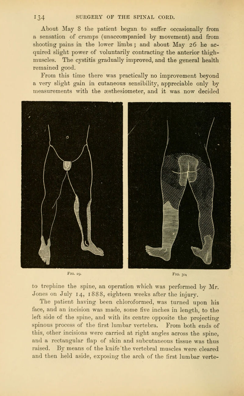 About May 8 the patient began to suffer occasionally from a sensation of cramps (unaccompanied by movement) and from shooting pains in the lower limbs ; and about May 26 he ac- quired slight power of voluntarily contracting the anterior thigh- muscles. The cystitis gradually improved, and the general health remained good. From this time there was practically no improvement beyond a very slight gain in cutaneous sensibility, appreciable only by measurements with the resthesiometer, and it was now decided i^'iu. 2i>- Fio. 30, to trephine the spine, an operation which was performed by Mr. Jones on July 14, 1888, eighteen weeks after the injury. The patient having been chloroformed, was turned upon his face, and an incision was made, some five inches in length, to the left side of the spine, and with its centre opposite the projecting spinous process of the first lumbar vertebra. From both ends of tliis, other incisions were carried at right angles across the spine, and a rectangular flap of skin and subcutaneous tissue was thus raised. By means of the knife the vertebral muscles were cleared and then held aside, exposing the arch of the first lumbar verte-