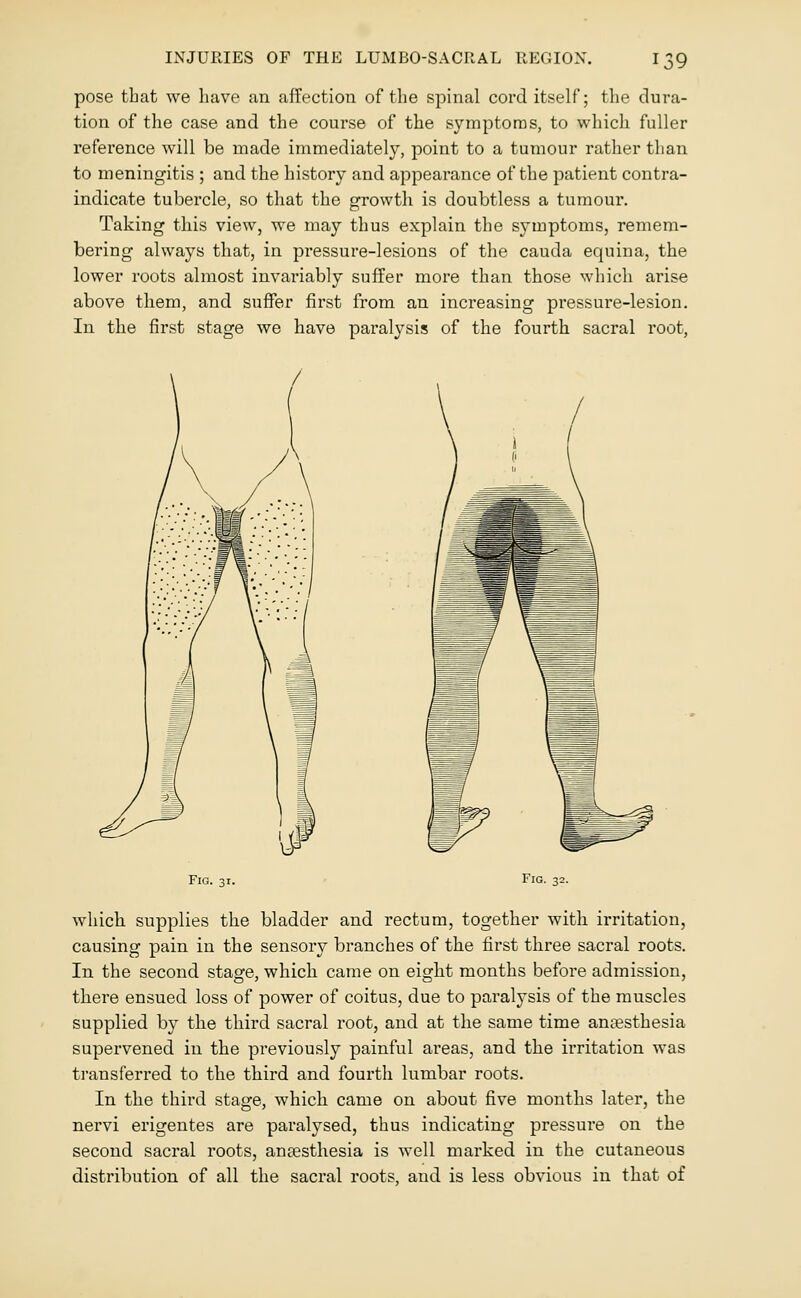 pose tbat we have an affection of tlie spinal cord itself; the dura- tion of the case and the course of the symptoms, to which fuller reference will be made immediately, point to a tumour rather than to meningitis ; and the history and appearance of the patient contra- indicate tubercle, so that the growth is doubtless a tumour. Taking this view, we may thus explain the symptoms, remem- bering always that, in pressure-lesions of the cauda equina, the lower roots almost invariably suffer more than those which arise above them, and suffer first from an increasing pressure-lesion. In the first stage we have paralysis of the fourth sacral root, Fig. 31. Fig. 32. which supplies the bladder and rectum, together with irritation, causing pain in the sensory branches of the first three sacral roots. In the second stage, which came on eight months before admission, there ensued loss of power of coitus, due to paralysis of the muscles supplied by the third sacral root, and at the same time anesthesia supervened in the previously painful areas, and the irritation was transferred to the third and fourth lumbar roots. In the third stage, which came on about five months later, the nervi erigentes are paralysed, thus indicating pressure on the second sacral roots, anaesthesia is well marked in the cutaneous distribution of all the sacral roots, and is less obvious in that of