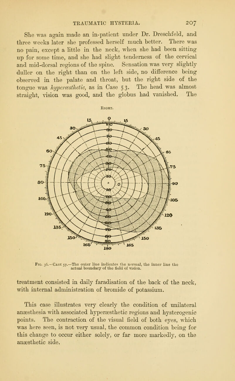 She was again made an in-patient under Dr. Dresclifeld, and three weeks later she professed herself much better. There was no pain, except a little in the neck, when she had been sitting up for some time, and she had slight tenderness of the cervical and mid-dorsal regions of the spine. Sensation was very slightly duller on the right than on the left side, no difference being observed in the palate and throat, but the right side of the tongue was hypcncsthdic, as in Case 53. The head was almost straight, vision was good, and the globus had vanished. The 10& I80 Fig. 36.—Case 57.—The outer line indicates the normal, the inner line the actual boundary of the field of vision. treatment consisted in daily faradisation of the back of the neck, with internal administration of bromide of potassium. This case illustrates very clearly the condition of unilateral ansesthesia with associated hyper^sthetic regions and hysterogenic points. The contraction of the visual field of both eyes, which was here seen, is not very usual, the common condition being for this change to occur either solely, or far more markedly, on the ansesthetic side.