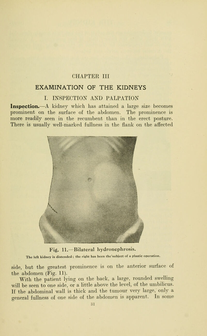 CHAPTER III EXAMINATION OF THE KIDNEYS I. INSPECTION AND PALPATION Inspection.—A kidney which has attained a large size becomes prominent on the surface of the abdomen. The prominence is more readily seen in the recumbent than in the erect posture. There is usually well-niarked fullness in the flank on the affected Fig. 11.—Bilateral hydronephrosis. The left kidney is distended ; the right has been the'subject of a plastic operation. side, but the greatest prominence is on the anterior surface of the abdomen (Fig. 11). With the patient lying on the back, a large, rounded swelling will be seen to one side, or a little above the level, of the umbiUcus. If the abdominal wall is thick and the tumour very large,' only a general fullness of one side of the abdomen is apparent. In some