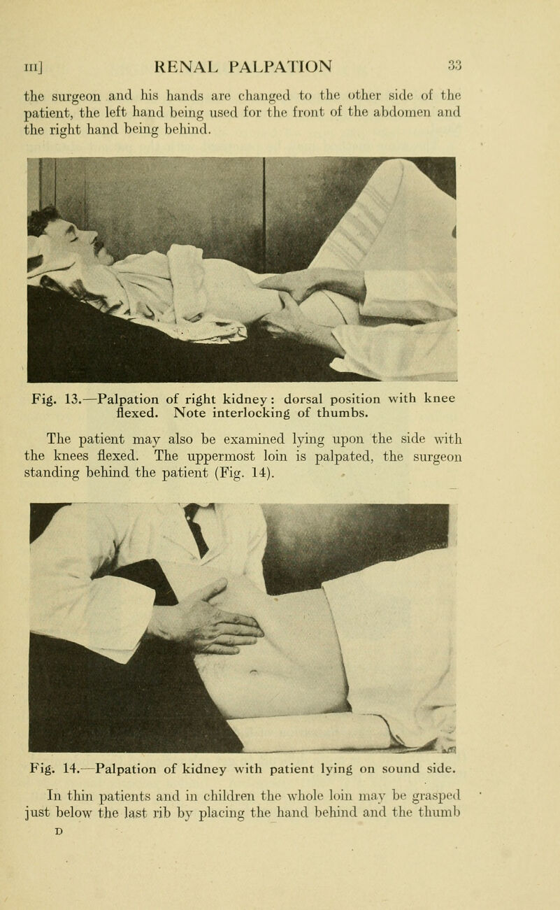 the surgeon and his hands are changed to the (;ther side of the patient, the left hand being used for the front of the abdomen and the right hand being behind. Fig. 13.—Palpation of right kidney: dorsal position with knee flexed. Note interlocking of thumbs. The patient may also be examined lying upon the side with the knees flexed. The uppermost loin is palpated, the surgeon standing behind the patient (Fig. 14). Fig. 14.—Palpation of kidney with patient lying on sound side. In thin patients and in children the whole loin may be grasped just below the last rib by placing the hand behind and the thumb