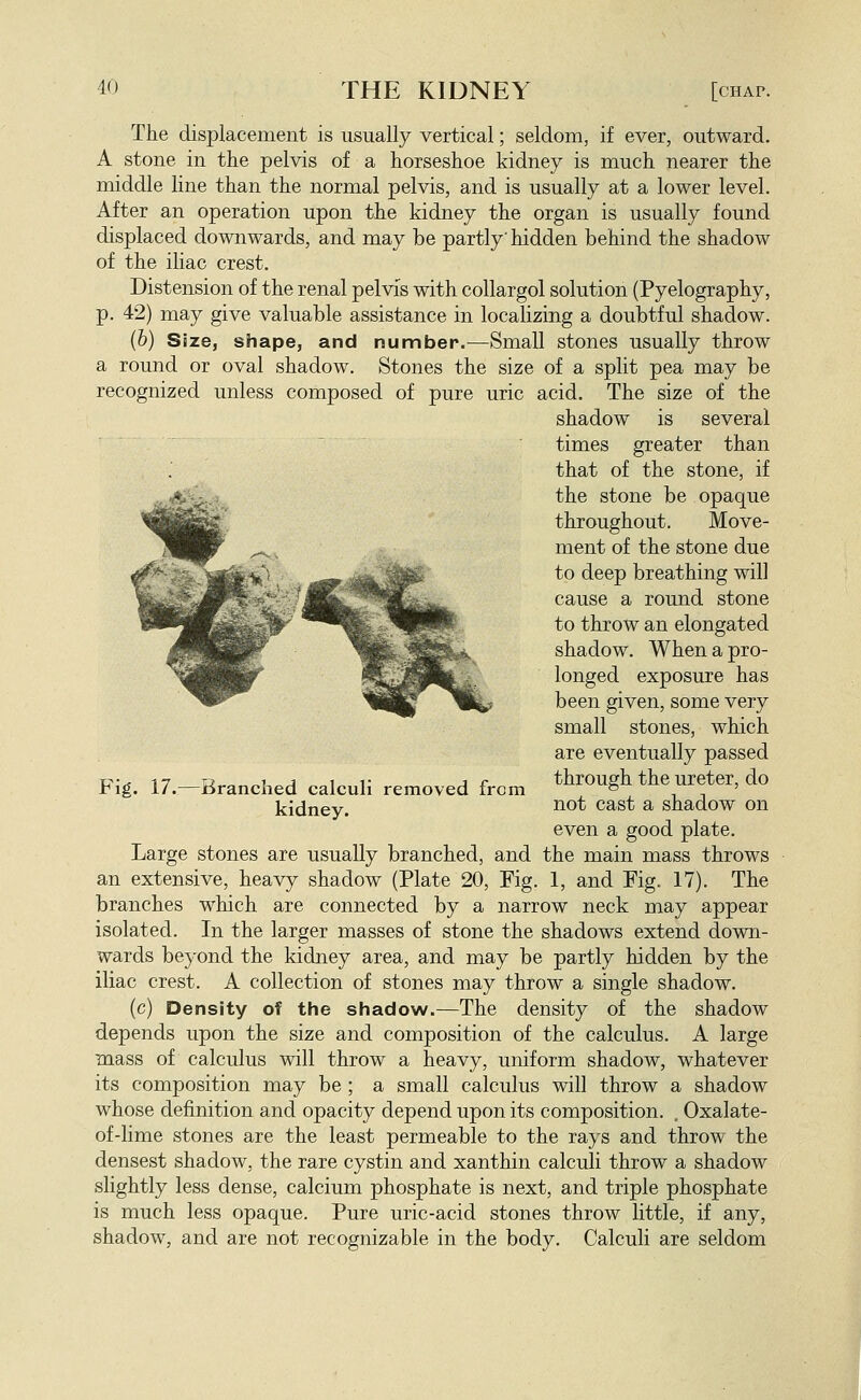 [chap. The displacement is usually vertical; seldom, if ever, outward. A stone in the pelvis of a horseshoe kidney is much nearer the middle line than the normal pelvis, and is usually at a lower level. After an operation upon the kidney the organ is usually found displaced downwards, and may be partly' hidden behind the shadow of the iliac crest. Distension of the renal pelvis with coUargol solution (Pyelography, p. 42) may give valuable assistance in localizing a doubtful shadow. (b) Size, shape, and number.—Small stones usually throw a round or oval shadow. Stones the size of a split pea may be recognized unless composed of pure uric acid. The size of the shadow is several times greater than that of the stone, if the stone be opaque throughout. Move- ment of the stone due to deep breathing will cause a round stone to throw an elongated shadow. When a pro- longed exposure has been given, some very small stones, which are eventually passed through the ureter, do not cast a shadow on even a good plate. Large stones are usually branched, and the main mass throws an extensive, heavy shadow (Plate 20, Fig. 1, and Fig. 17). The branches which are connected by a narrow neck may appear isolated. In the larger masses of stone the shadows extend down- wards beyond the kidney area, and may be partly hidden by the iliac crest. A collection of stones may throw a single shadow. (c) Density of the shadow.—The density of the shadow depends upon the size and composition of the calculus. A large mass of calculus will throw a heavy, uniform shadow, whatever its composition may be; a small calculus will throw a shadow whose definition and opacity depend upon its composition. , Oxalate- of-lime stones are the least permeable to the rays and throw the densest shadow, the rare cystin and xanthin calculi throw a shadow slightly less dense, calcium phosphate is next, and triple phosphate is much less opaque. Pure uric-acid stones throw little, if any, shadow, and are not recognizable in the body. Calculi are seldom Fig. 17.- -Branched calculi removed from kidney.