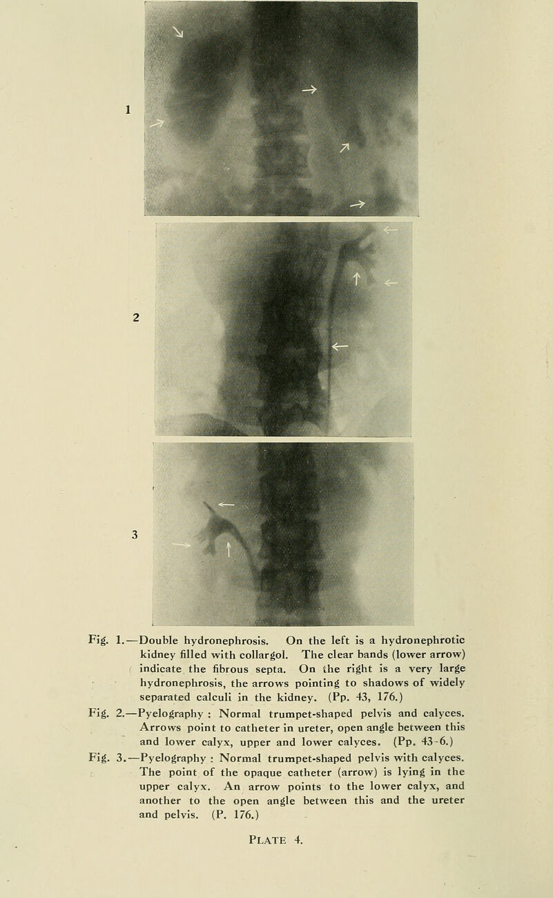 Fig. 1.—Double hydronephrosis. On the left is a hydronephrotic kidney filled with collargol. The clear bands (lower arrow) I indicate the fibrous septa. On the right is a very large hydronephrosis, the arrows pointing to shadows of widely separated calculi in the kidney. (Pp. 43, 176.) Fig. 2.—Pyelography : Normal trumpet-shaped pelvis and calyces. Arrows point to catheter in ureter, open angle between this and lower calyx, upper and lower calyces. (Pp. 43-6.) Fig. 3.—Pyelography: Normal trumpet-shaped pelvis with calyces. The point of the opaque catheter (arrow) is lying in the upper calyx. An arrow points to the lower calyx, and another to the open angle between this and the ureter and pelvis. (P. 176.)