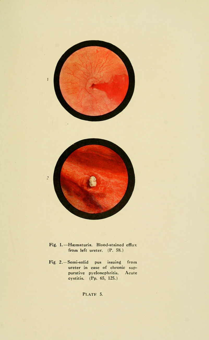 Fig. 1.—Heematuria. Blood-stained efflux from left ureter. (P. 58.) Fig. 2.—Semi-solid pus issuing from ureter in case of chronic sup- purative pyelonephritis. Acute cystitis. (Pp. 65, 125.) Plate 5.