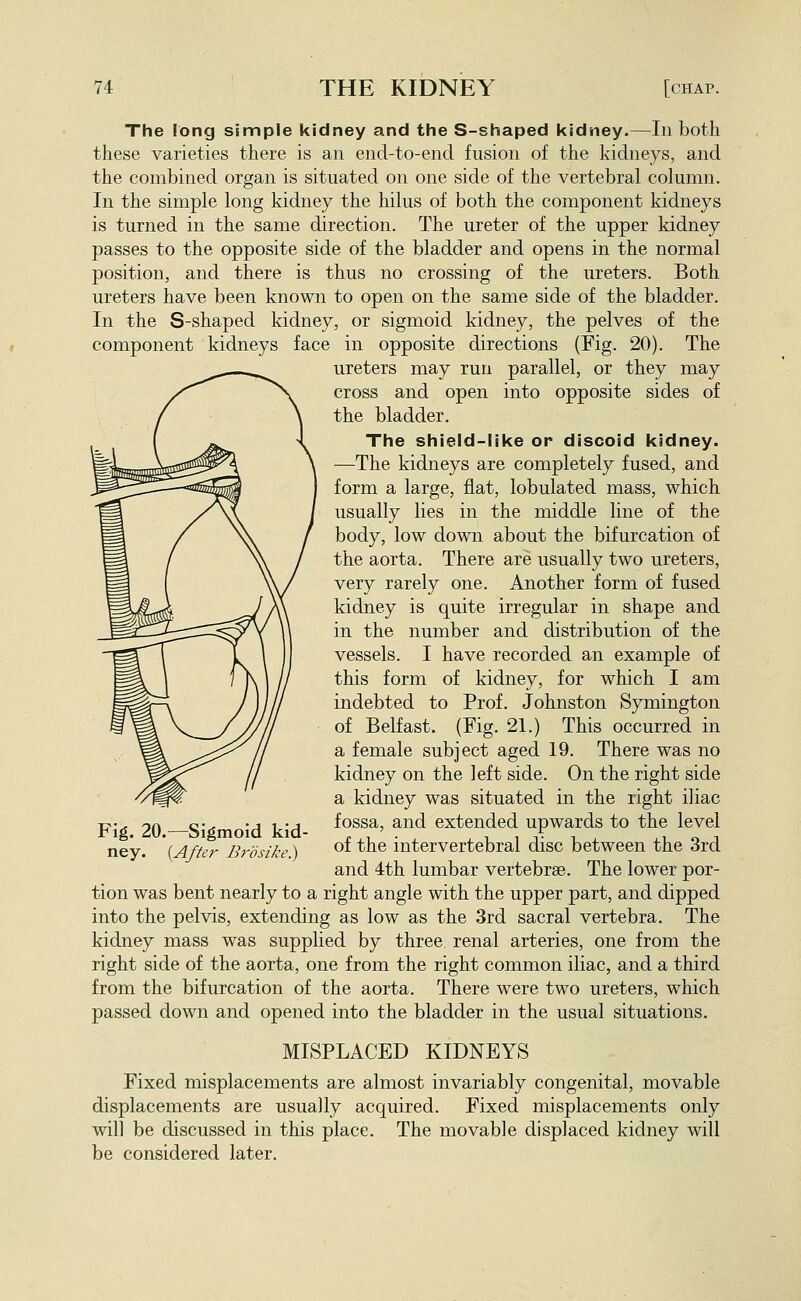 The long simple kidney and the S-shaped kidney.—In both these varieties there is an end-to-end. fusion of the kidneys, and the combined organ is situated on one side of the vertebral column. In the simple long kidney the hilus of both the component kidneys is turned in the same direction. The ureter of the upper kidney passes to the opposite side of the bladder and opens in the normal position, and there is thus no crossing of the ureters. Both ureters have been known to open on the same side of the bladder. In the S-shaped kidney, or sigmoid kidney, the pelves of the component kidneys face in opposite directions (Fig. 20). The ureters may run parallel, or they may cross and open into opposite sides of the bladder. The shield-like or discoid kidney. —The kidneys are completely fused, and form a large, flat, lobulated mass, which usually lies in the middle line of the body, low down about the bifurcation of the aorta. There are usually two ureters, very rarely one. Another form of fused kidney is quite irregular in shape and in the number and distribution of the vessels. I have recorded an example of this form of kidney, for which I am indebted to Prof. Johnston Symington of Belfast. (Fig. 21.) This occurred in a female subject aged 19. There was no kidney on the left side. On the right side a kidney was situated in the right iliac fossa, and extended upwards to the level of the intervertebral disc between the 3rd and 4th lumbar vertebrae. The lower por- tion was bent nearly to a right angle with the upper part, and dipped into the pelvis, extending as low as the 3rd sacral vertebra. The kidney mass was supplied by three renal arteries, one from the right side of the aorta, one from the right common iliac, and a third from the bifurcation of the aorta. There were two ureters, which passed down and opened into the bladder in the usual situations. MISPLACED KIDNEYS Fixed misplacements are almost invariably congenital, movable displacements are usually acquired. Fixed misplacements only will be discussed in this place. The movable displaced kidney will be considered later. Fig. 20.—Sigmoid kid- ney. {After Br OS ike.)