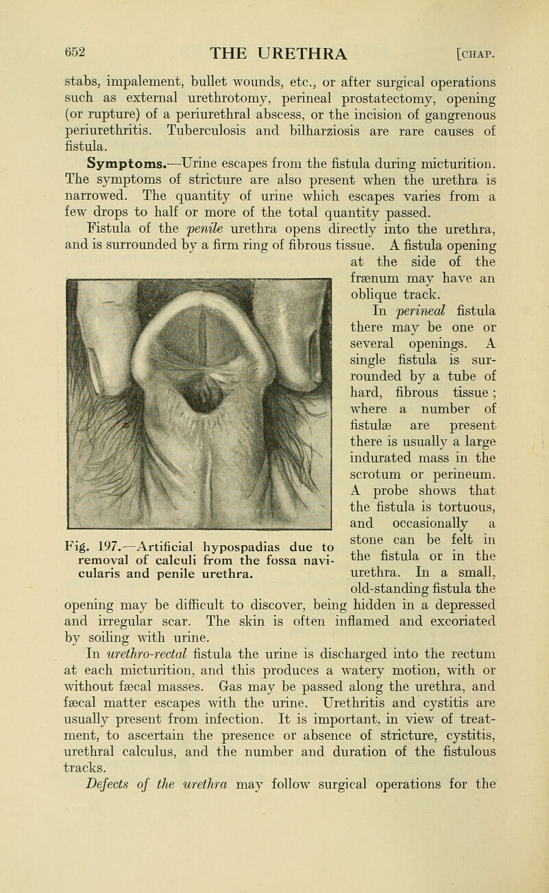 stabs, impalement, bullet womids, etc., or after surgical operations such as external urethrotomy, perineal prostatectomy, opening (or rupture) of a periurethral abscess, or the incision of gangrenous periurethritis. Tuberculosis and bilharziosis are rare causes of fistula. Symptoms.-—Urine escapes from the fistula during micturition. The symptoms of stricture are also present when the urethra is narrowed. The quantity of urine which escapes varies from a few drops to half or more of the total quantity passed. Fistula of the 'penile urethra opens directly into the urethra, and is surrounded by a firm ring of fibrous tissue. A fistula opening at the side of the frsenum may have an oblique track. In 'perineal fistula there may be one or several openings. A single fistula is sur- rounded by a tube of hard, fibrous tissue; where a number of fistulse are present there is usually a large indurated mass in the scrotum or perineum. A probe shows that the fistula is tortuous, and occasionally a stone can be felt in the fistula or in the urethra. In a small, old-standing fistula the opening may be difficult to discover, being hidden in a depressed and irregular scar. The skin is often inflamed and excoriated by soiling with urine. In urethro-rectal fistula the urine is discharged into the rectum at each micturition, and this produces a watery motion, with or without fsecal masses. Gas may be passed along the urethra, and fsecal matter escapes with the urine. Urethritis and cystitis are usually present from infection. It is important, in view of treat- ment, to ascertain the presence or absence of stricture, cystitis, urethral calculus, and the number and duration of the fistulous tracks. Defects of the urethra may follow surgical operations for the Fig. 197.—Artificial hypospadias due to removal of calculi from the fossa navi- cularis and penile urethra.